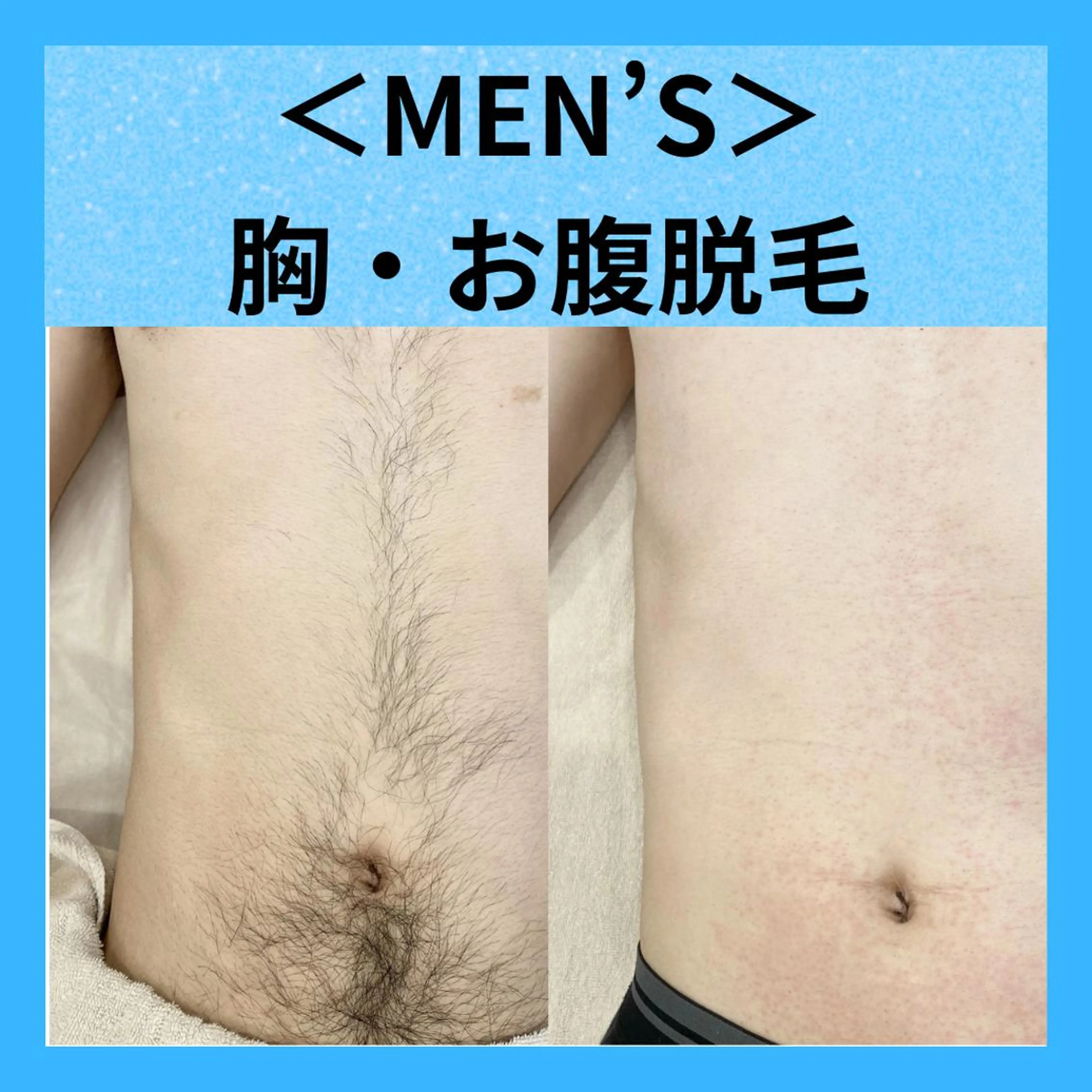 【メンズ脱毛】　胸+お腹脱毛 ￥2,200の写真