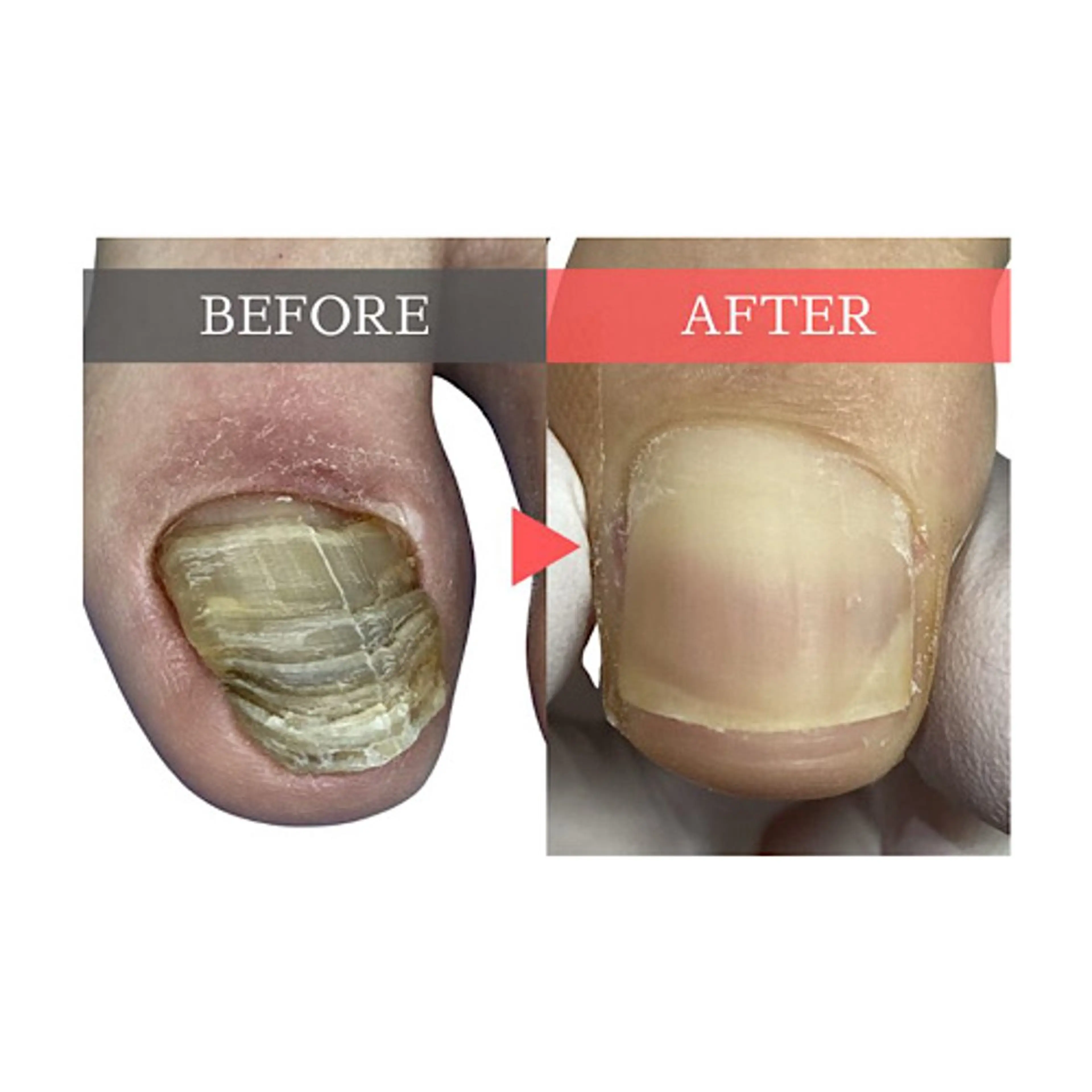 【分厚い爪・変形爪・深爪1指＋爪切り】トラブルが起きている爪を正常な爪になるようにケア致します💁‍♀️の写真