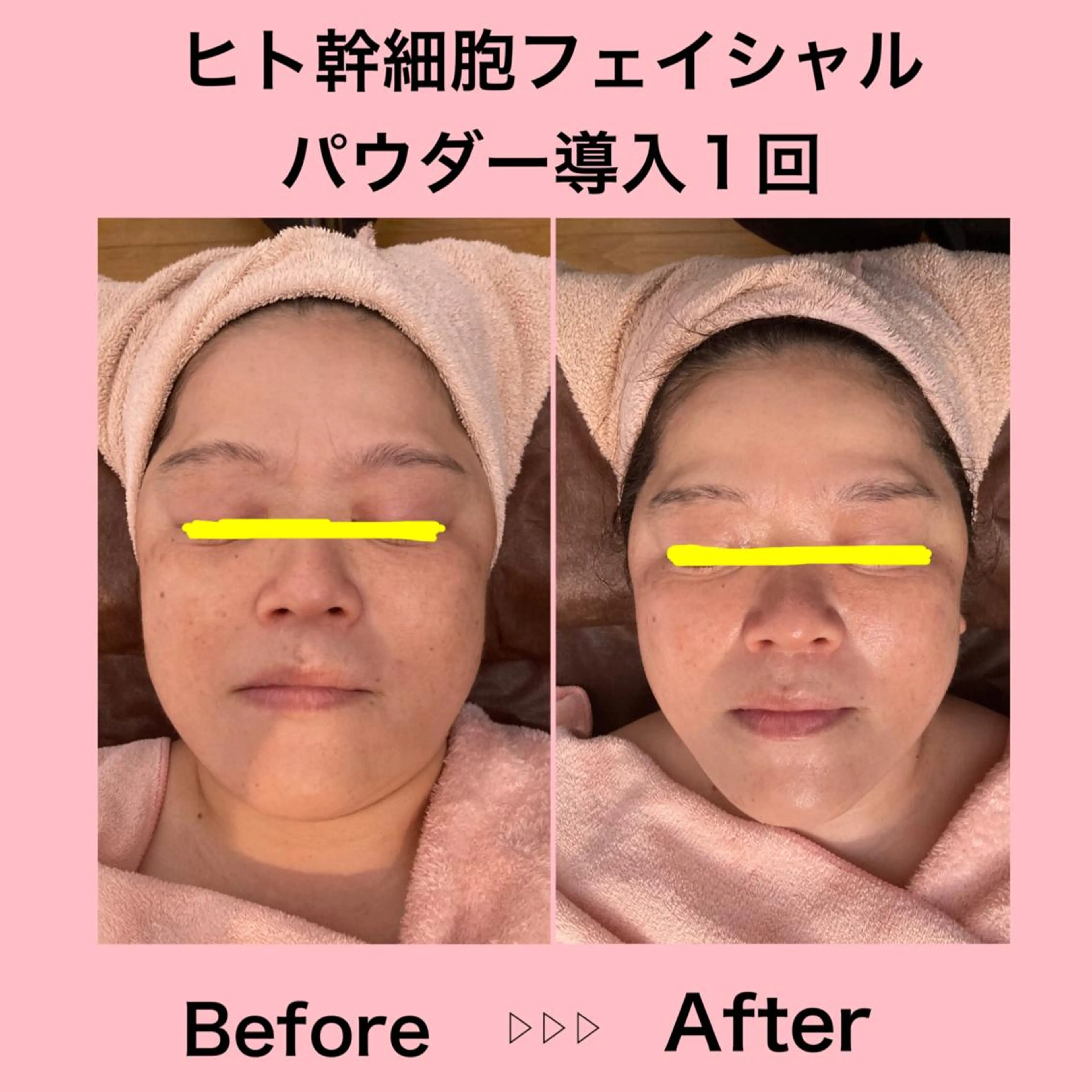ヒト幹細胞フェイシャルパウダー導入コースの写真