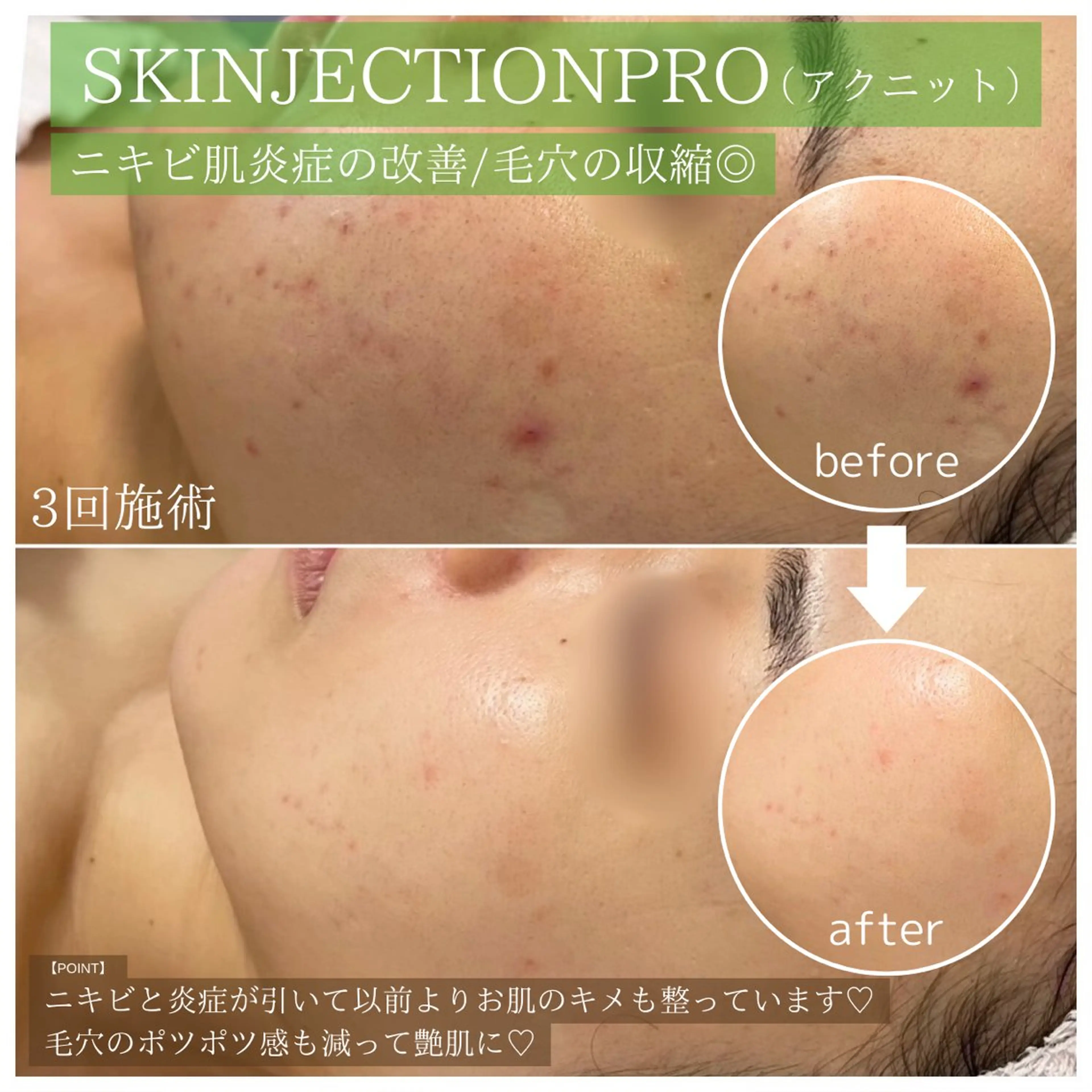 韓国エステ式ポテンツァ💉🇰🇷スキンジェクション（アクニット💚）初のフィラートリートメント/ニキビケアにはこれ❣️の写真