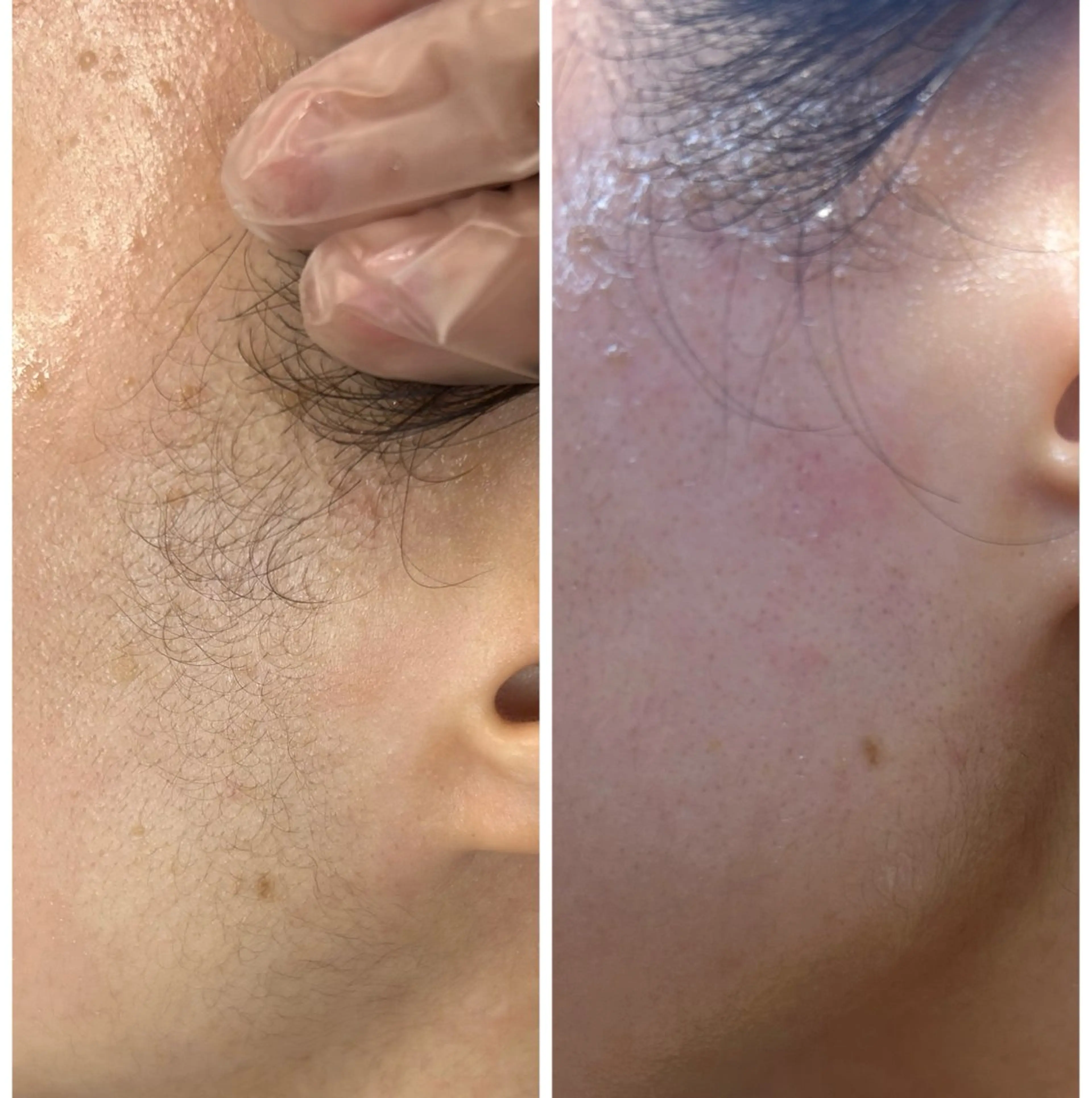 エステ beauty  salon sorelle所属・産毛角質ケア/艶肌 フェイシャルワックスのエステ・リラクイメージ