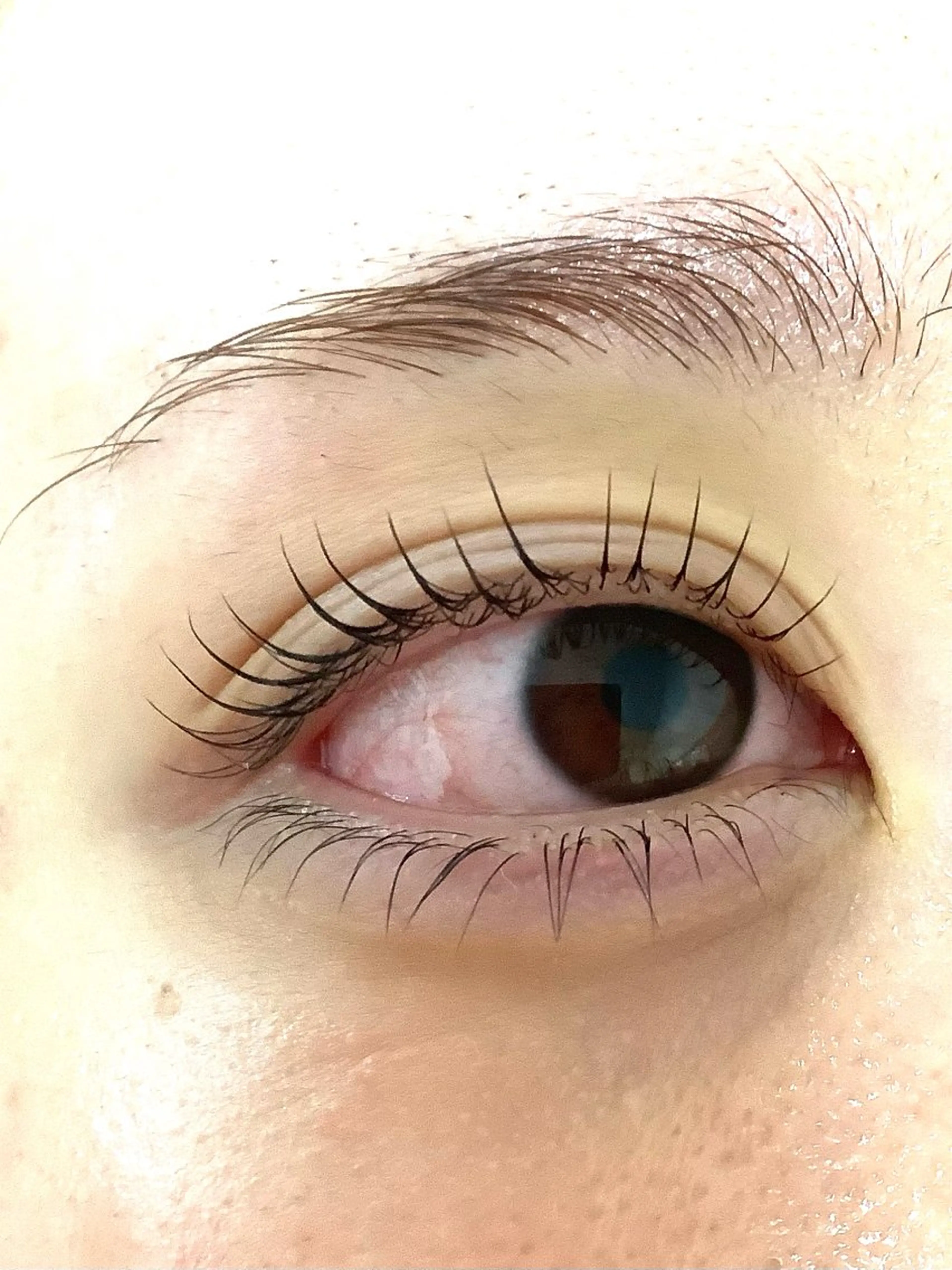 【上下マツパ＋マイクロニードルピーリング✨】マツパと纏めて気になるニキビ跡や毛穴ケア😊の写真