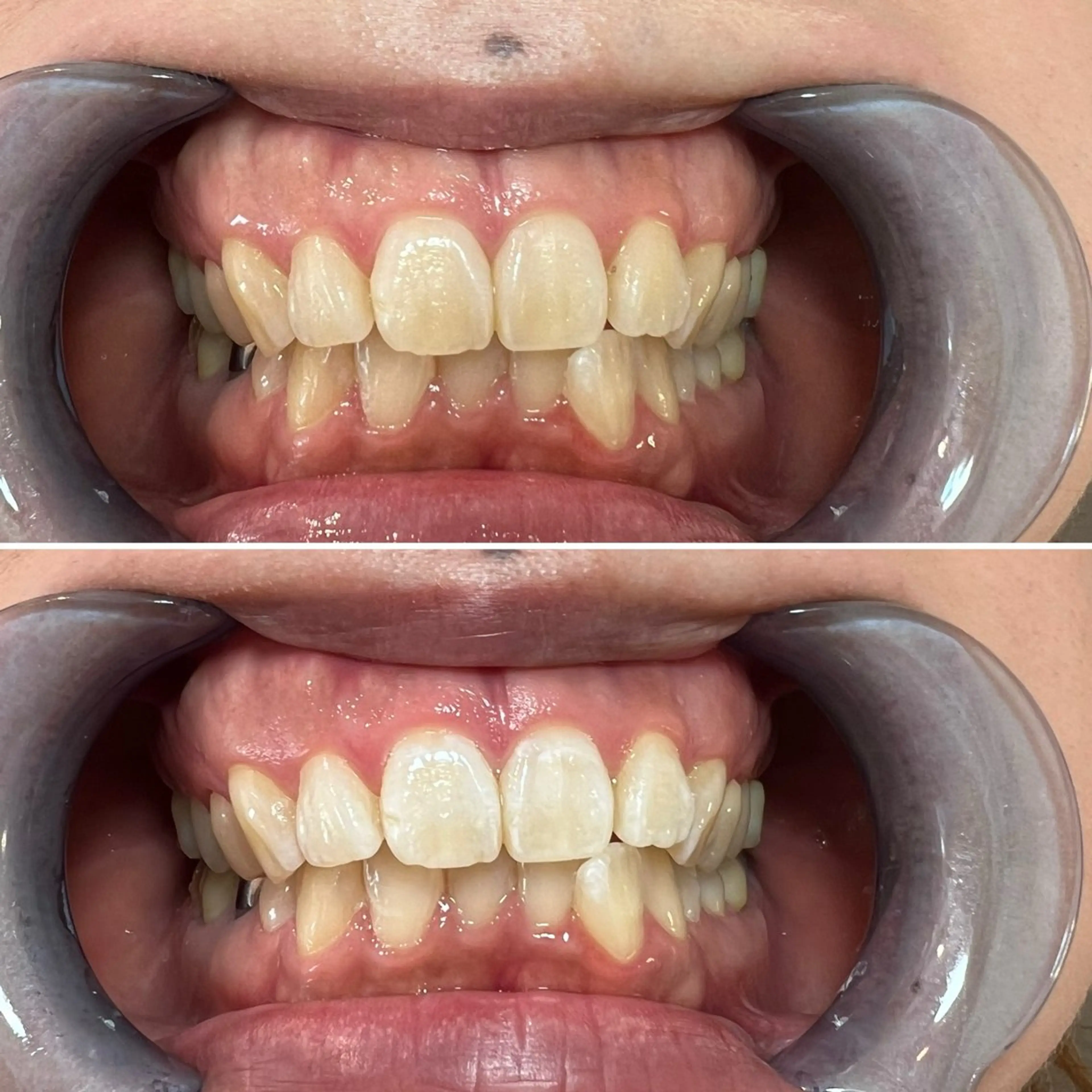 セルフホワイトニング Shineeのエステ・リラクイメージ