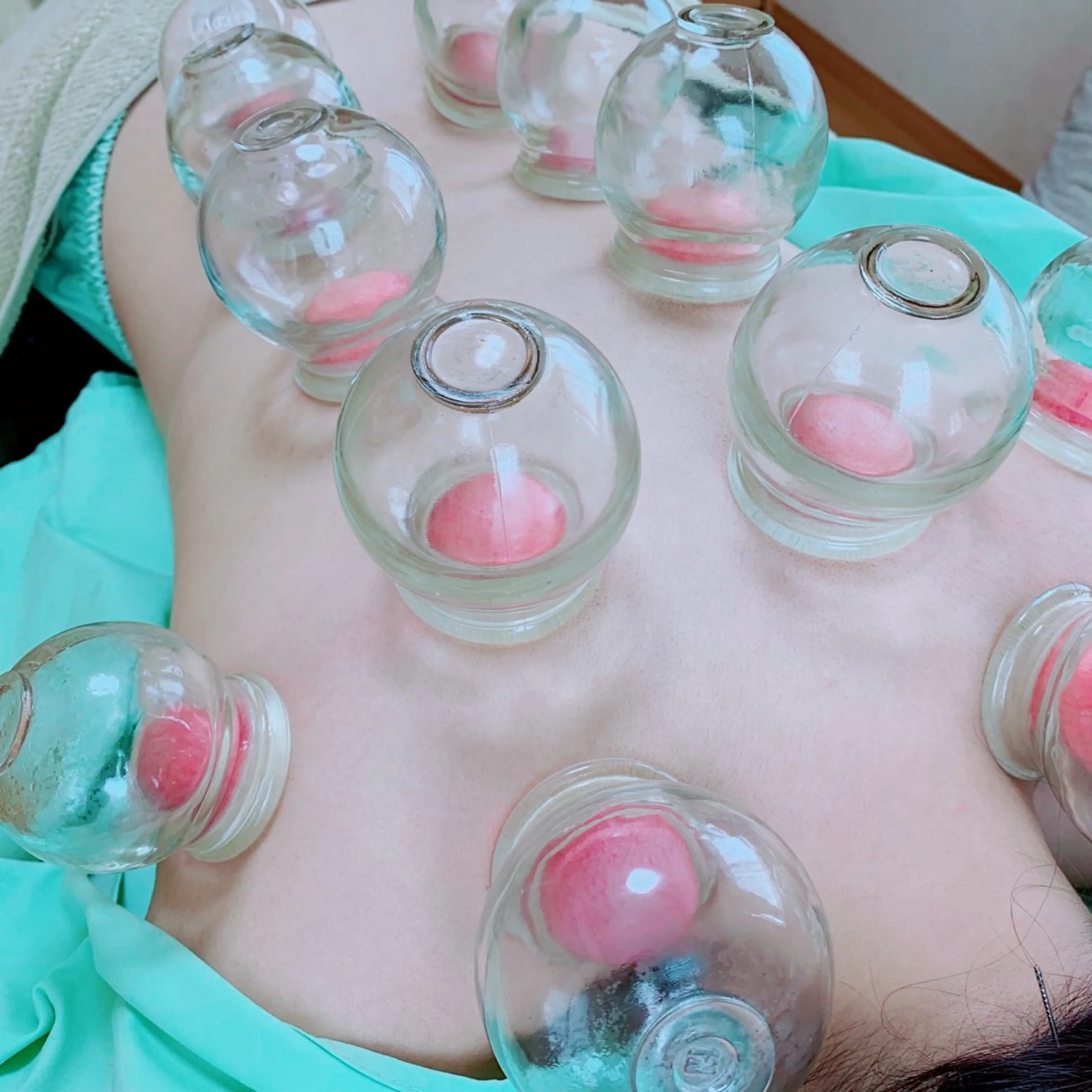 吸玉(カッピング)の写真