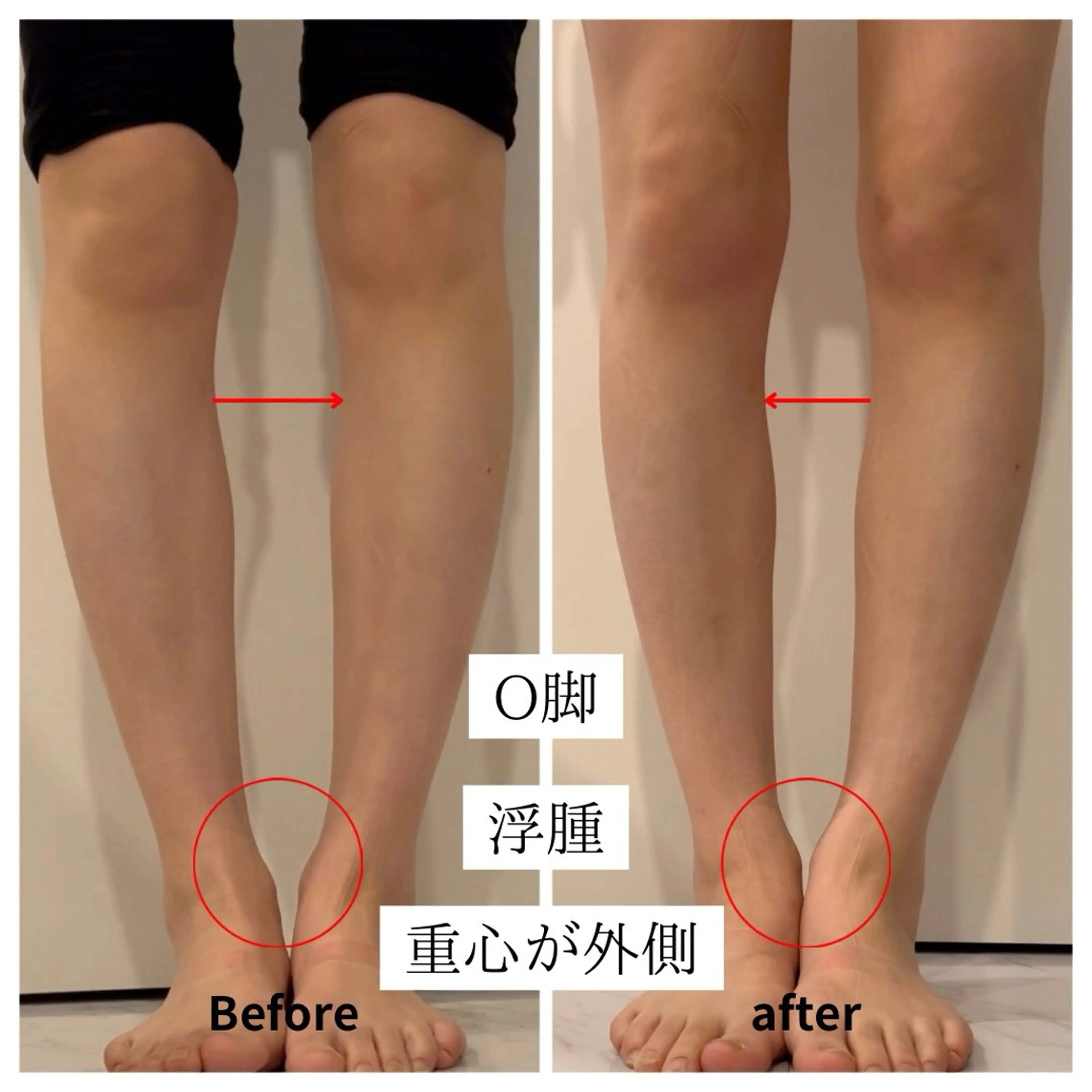 【美脚矯正】O脚・膝下の歪み改善へ✨骨格×筋膜ケアで整える体感コースの写真