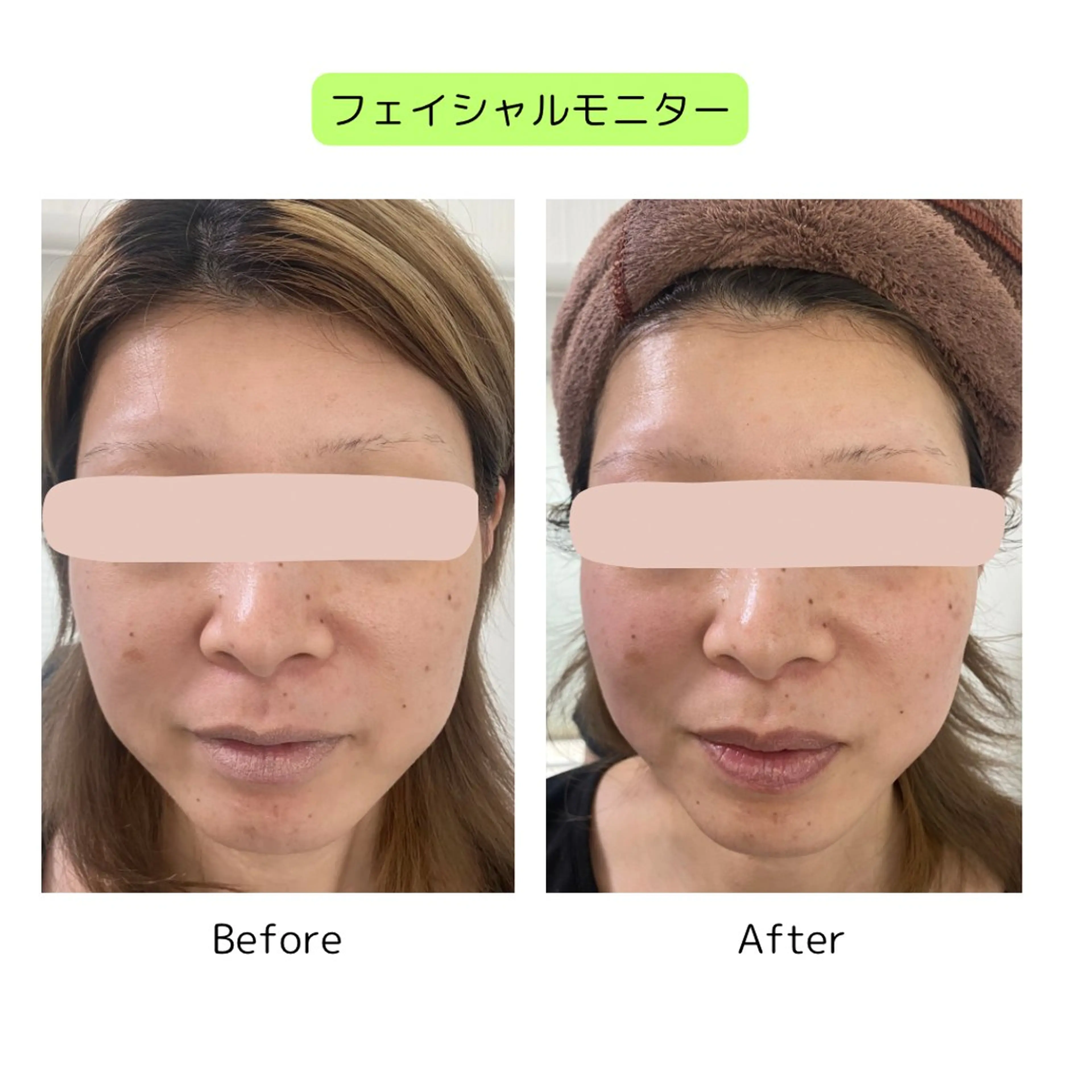 植物性ミネラルで整える小顔フェイシャル＋快楽ヘッドスパの写真