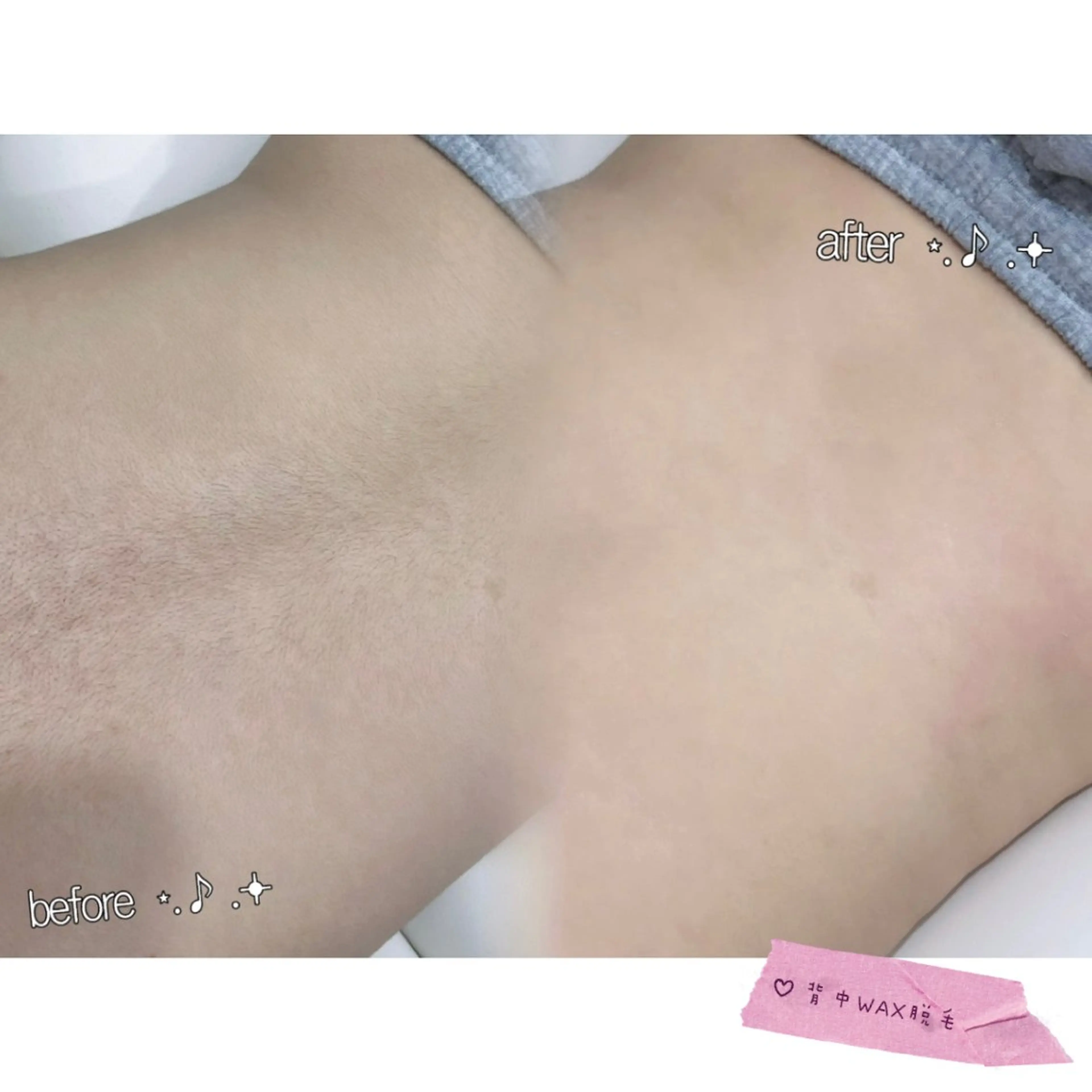 【新規Open】ワックス脱毛(背中）の写真