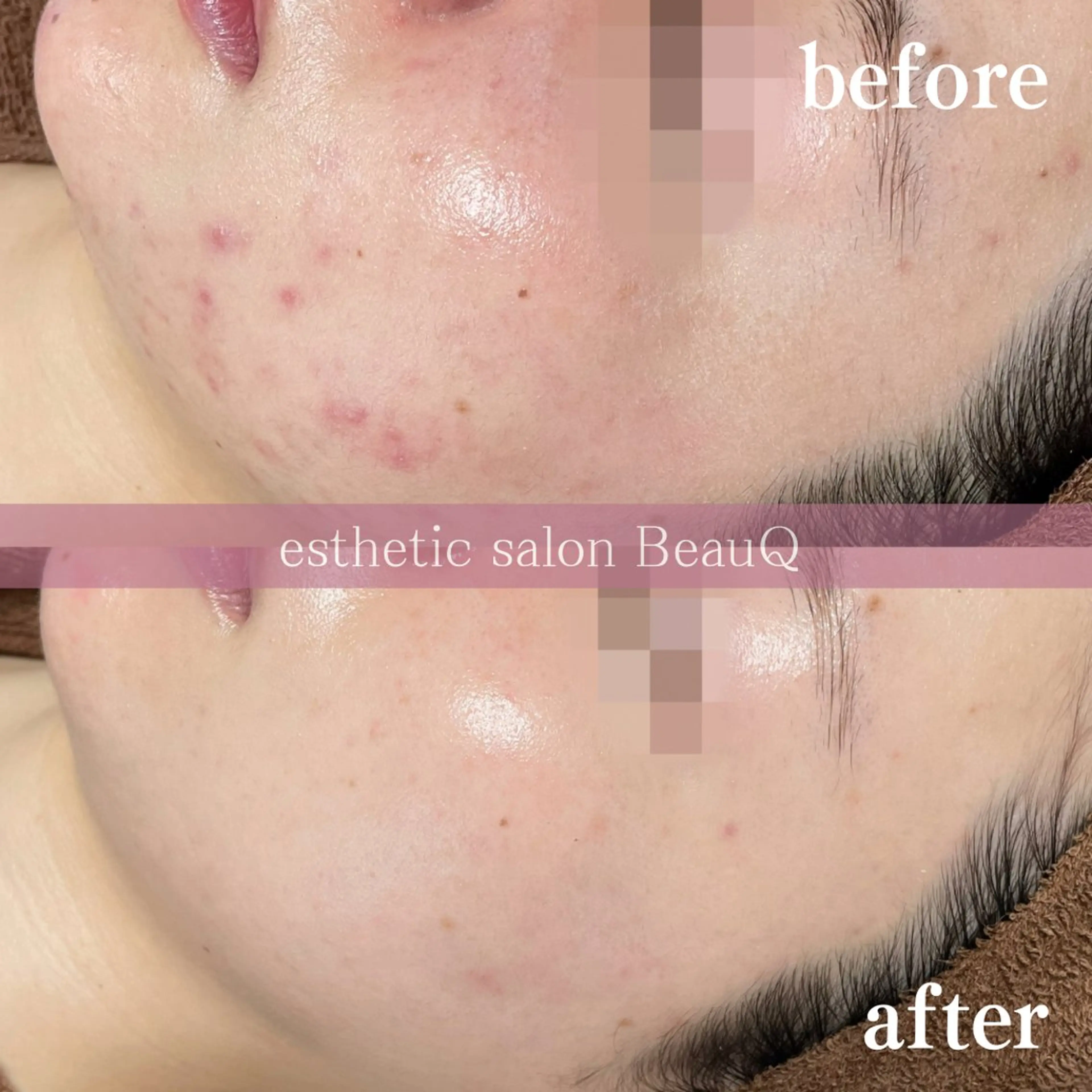 肌質改善/ブライダル 水上百華のエステ・リラクイメージ