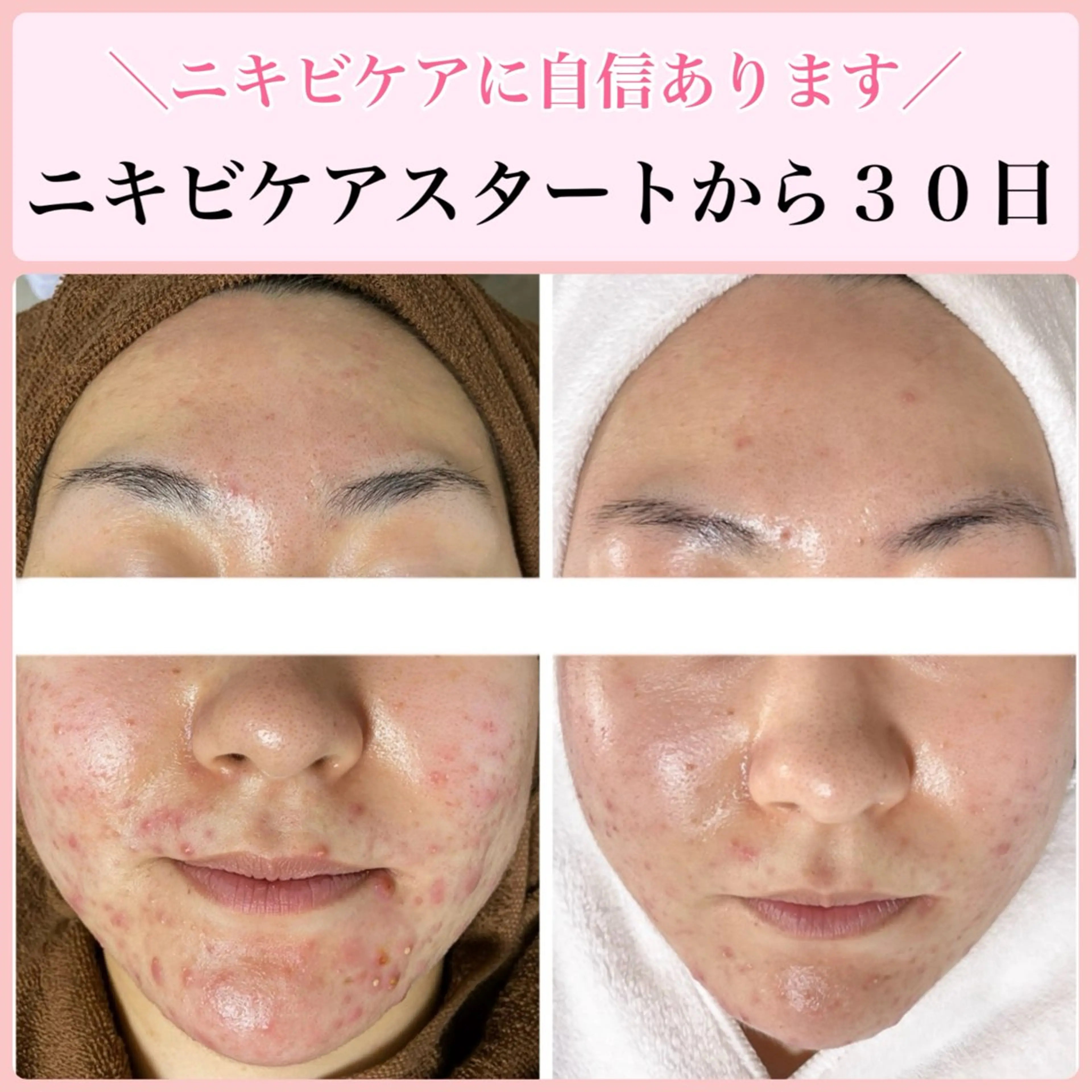 エステ リラク ニキビ・ 肌荒れ専門店のエステ・リラクイメージ