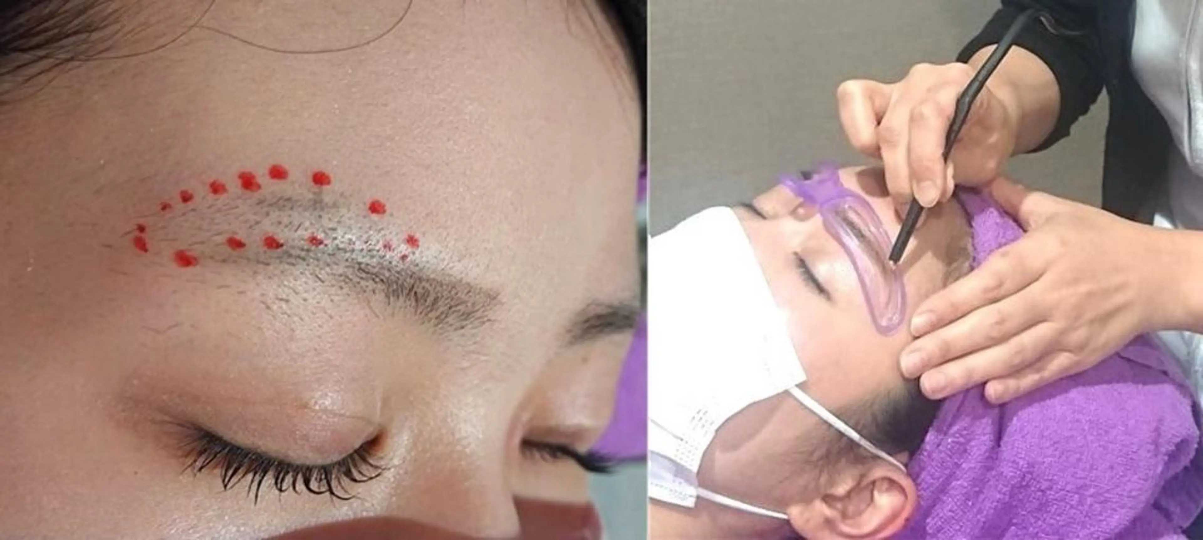 【女性脱毛】ピンポイント1本処理の1回完了脱毛/1本¥200×20本¥4000→¥999の写真