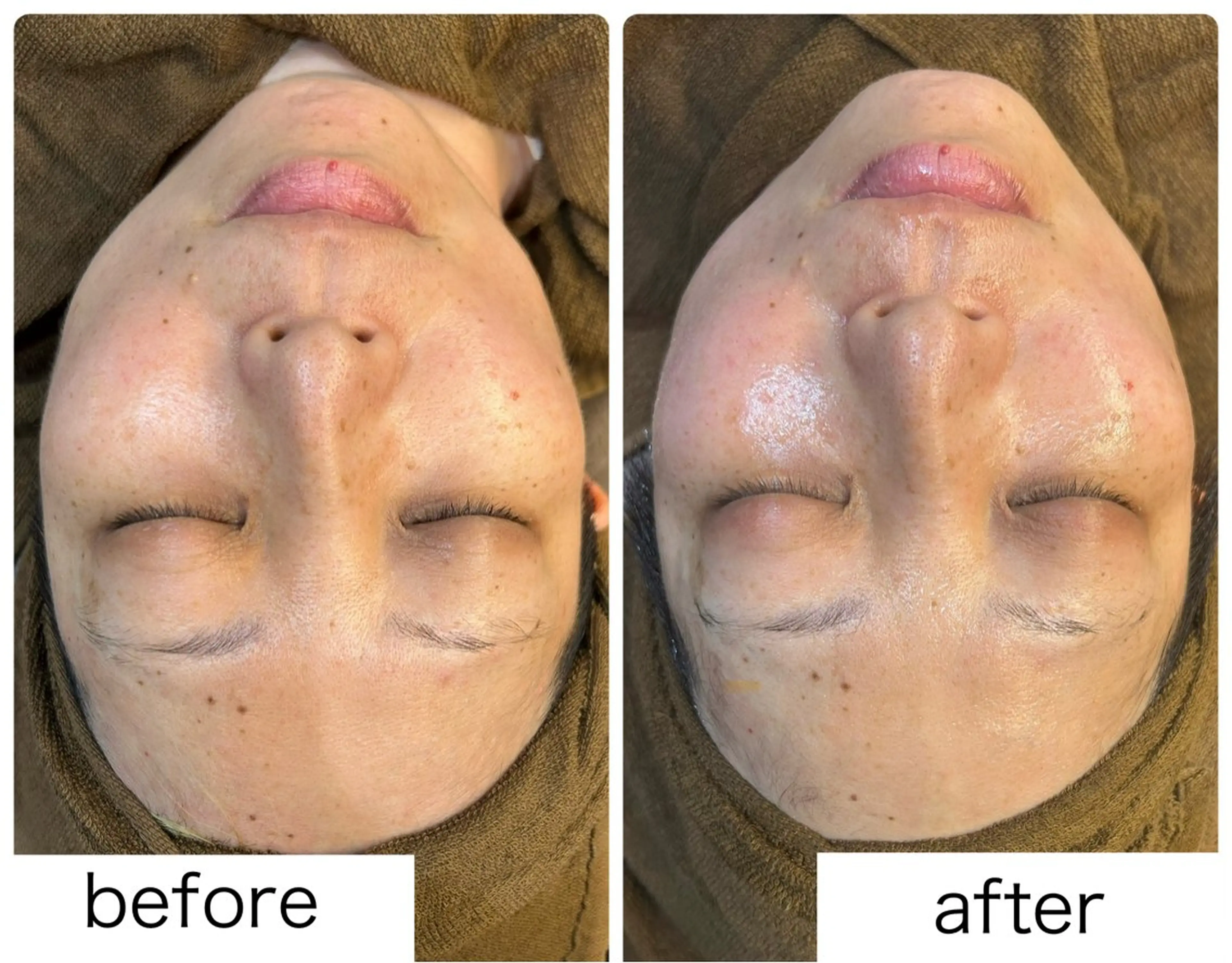 20名限定｜【黒ずみ毛穴集中ケア】毛穴洗浄×引き締め×水光肌フェイシャルの写真