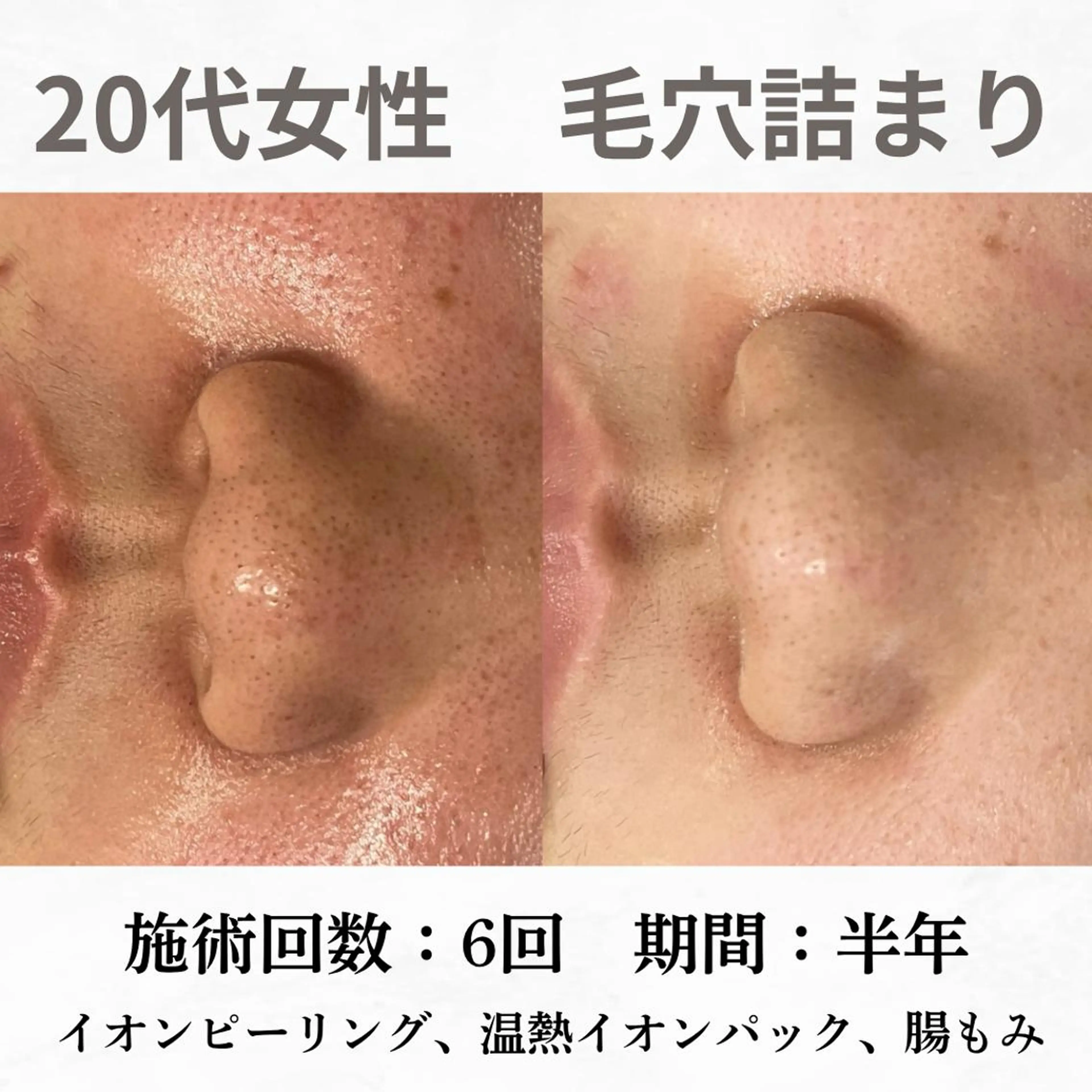 重度ニキビ専門🌷 ダウンタイムなしのエステ・リラクイメージ