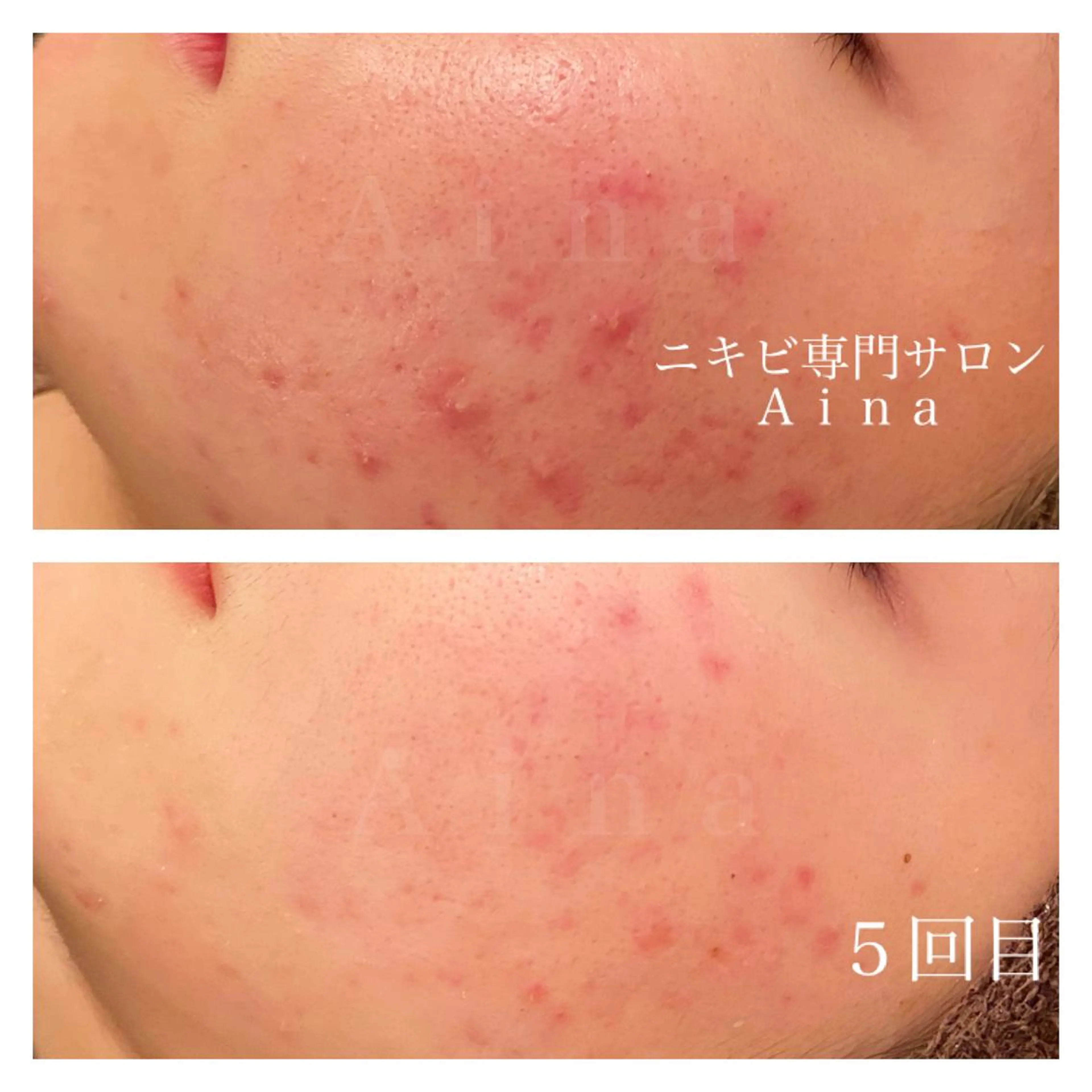 ロング カラー パーマ ヘアアレンジ メンズ キッズ ネイル マツエク・マツパ 赤色 エステ リラク ニキビ跡専門サロン Ａｉｎａのエステ・リラクイメージ