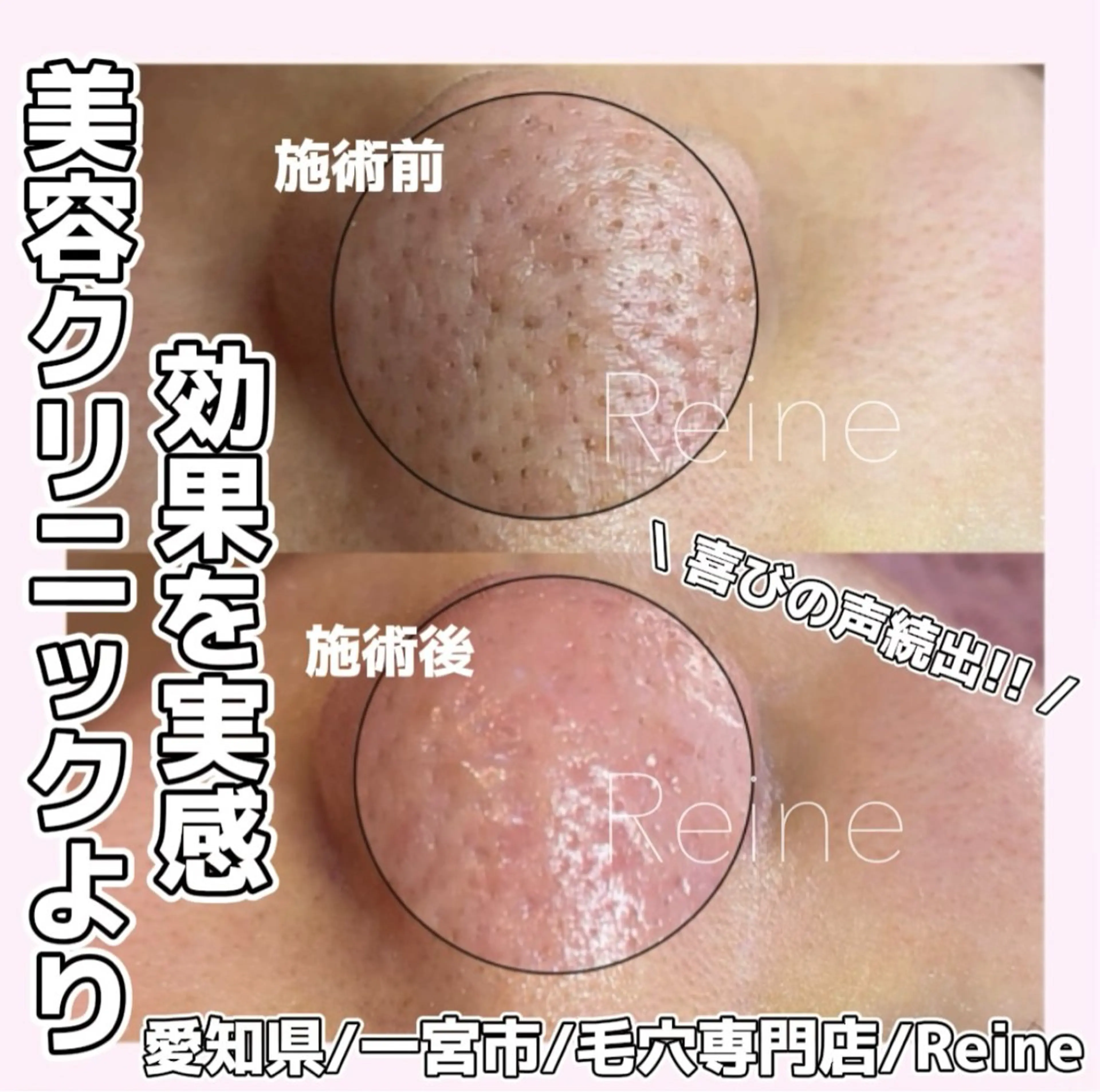 エステ Reine BeautySalon所属・毛穴/シミ肝斑/脱毛 横山梨里のエステ・リラクイメージ