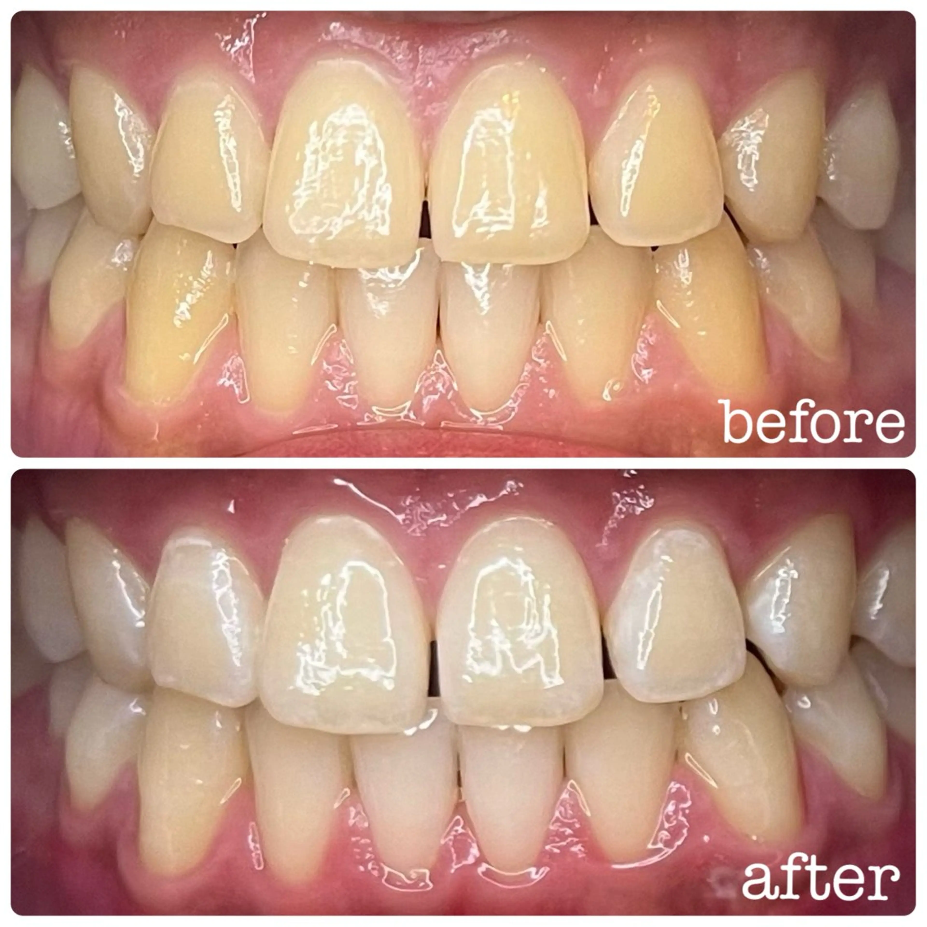 ✨ホワイトニング✨ナチュラルホワイトニング8分×3照射🦷🪥の写真