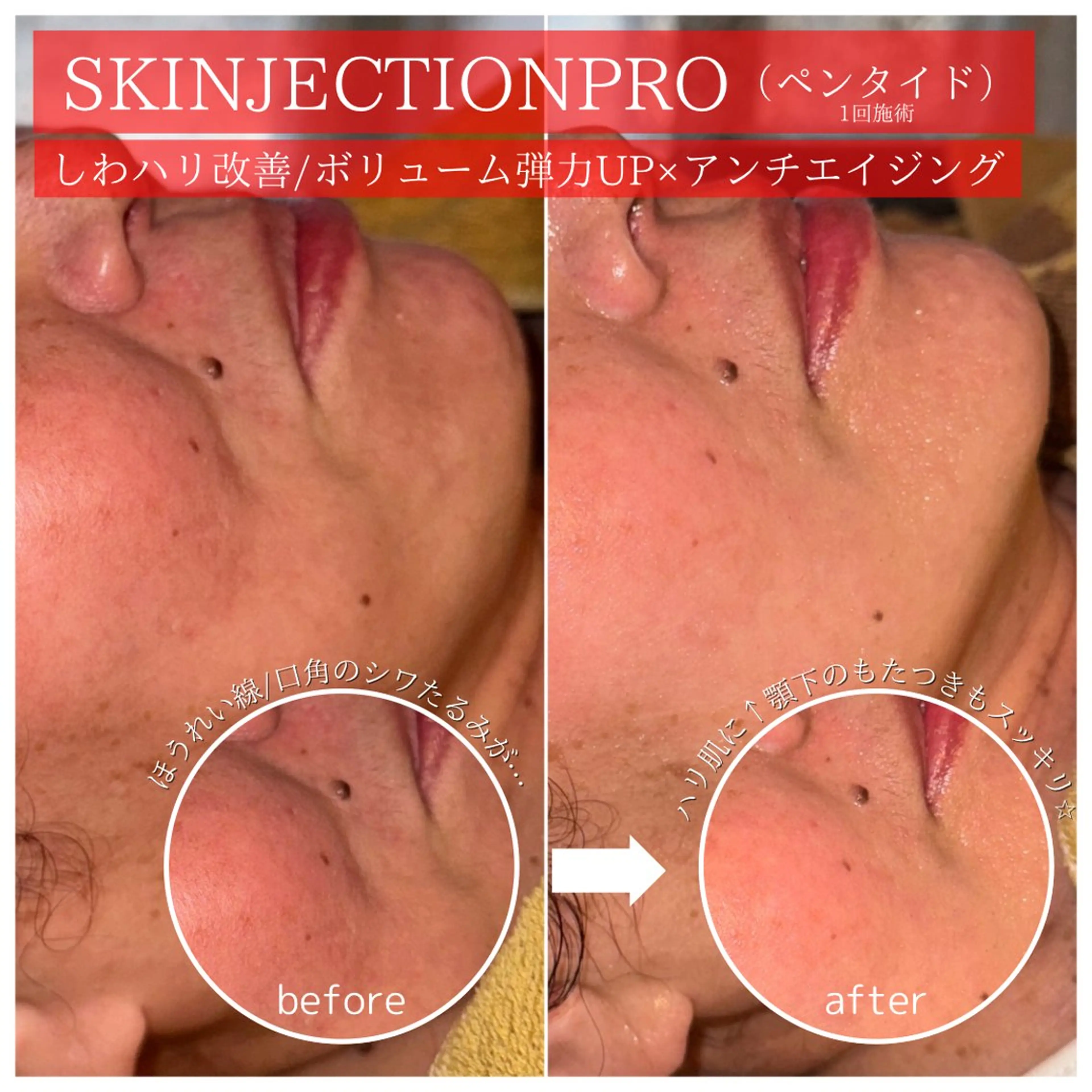 韓国エステ式リフティング🇰🇷スキンジェクション（ペンタイド）初のフィラートリートメント/エイジングケアにはこれ❣️の写真