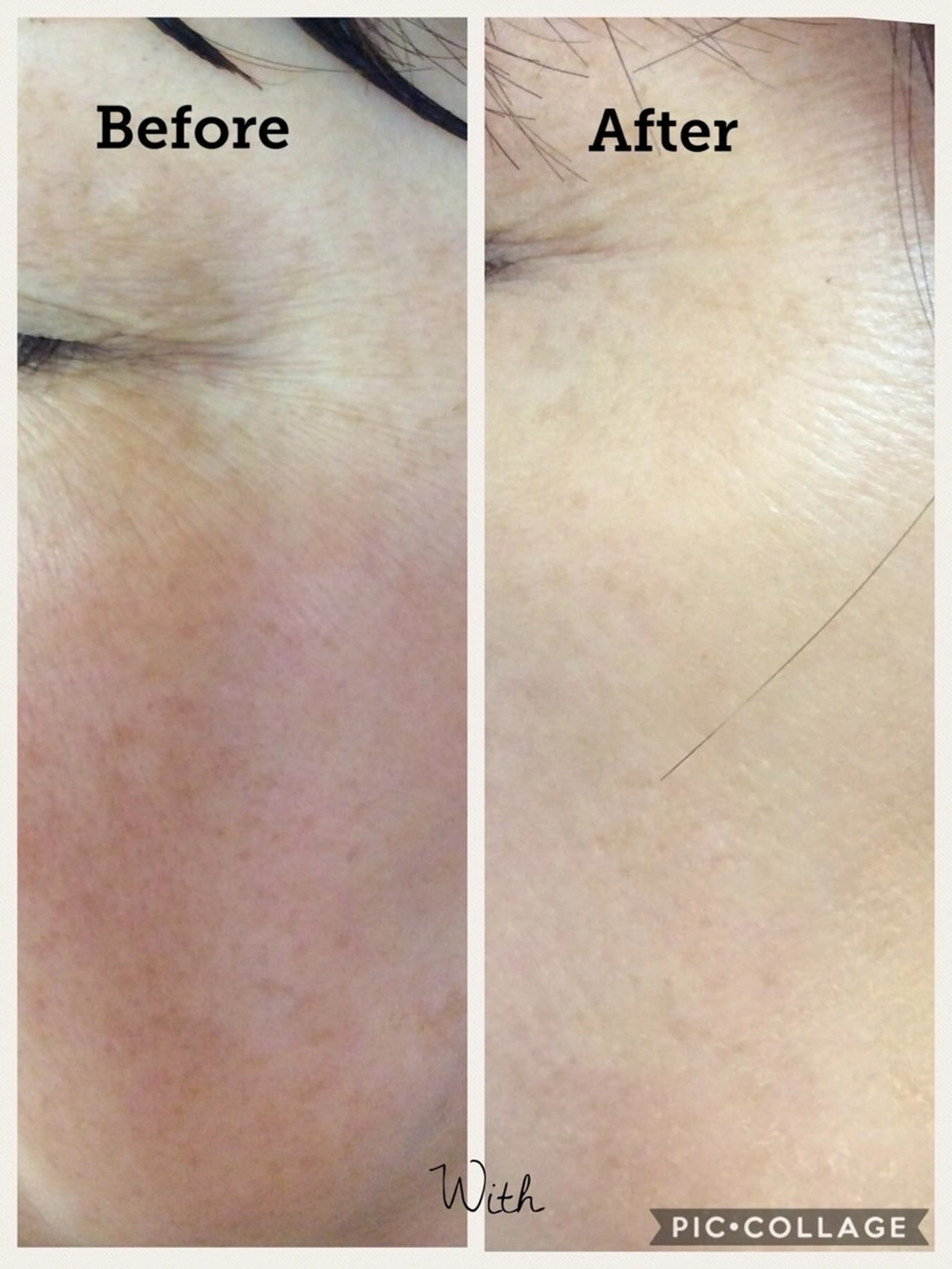 リベルハーブピーリング（お肌の生まれ変わり）剥離するピーリングです💕他社のピーリング剤より5​〜​6倍多い棘配合😎即効果の写真