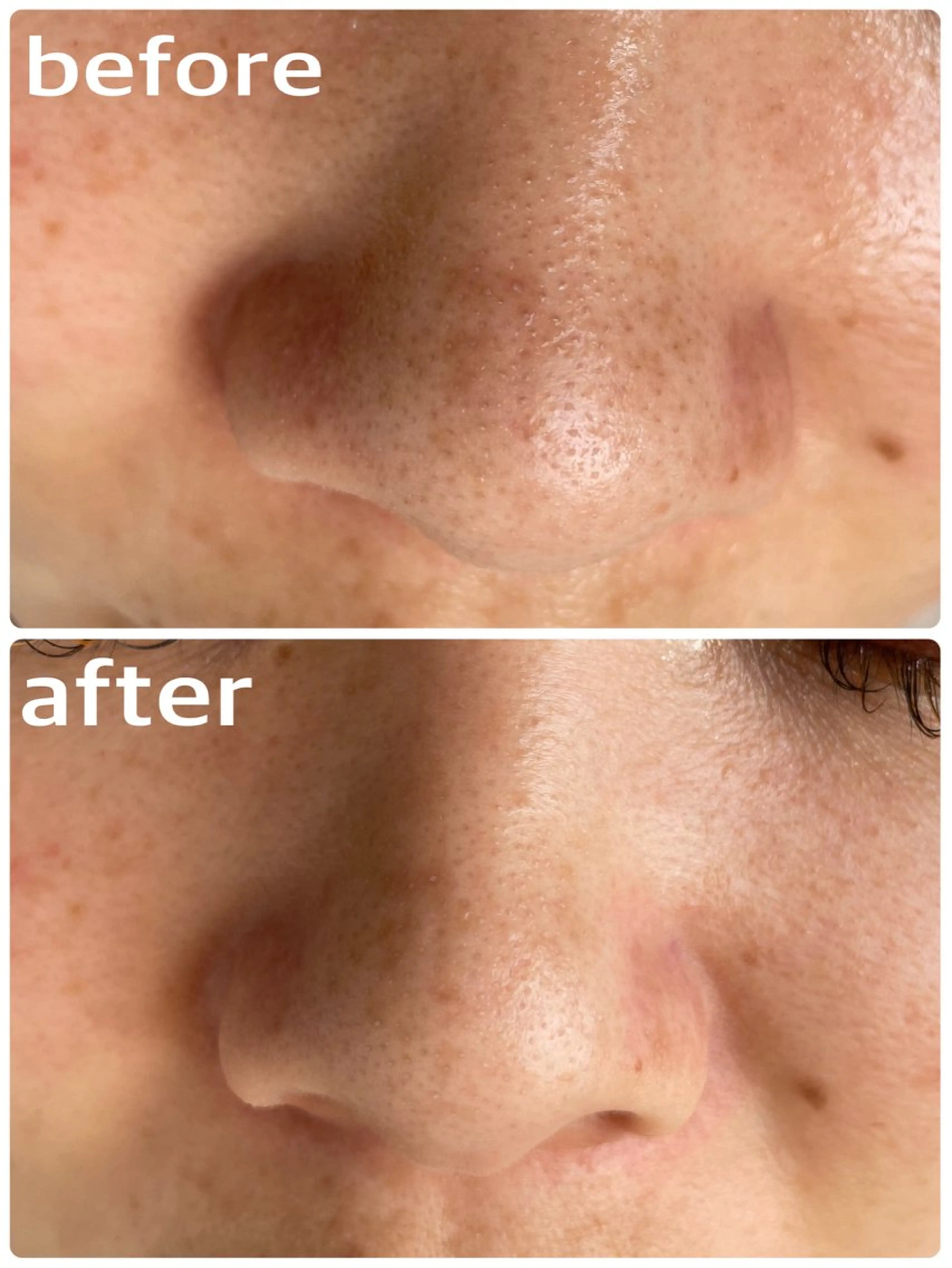 ミニモ限定価格3500円《超音波毛穴洗浄》顔全体の黒ずみ.皮脂汚れを大掃除🤍🖤お肌診断あり🖤🖤の写真