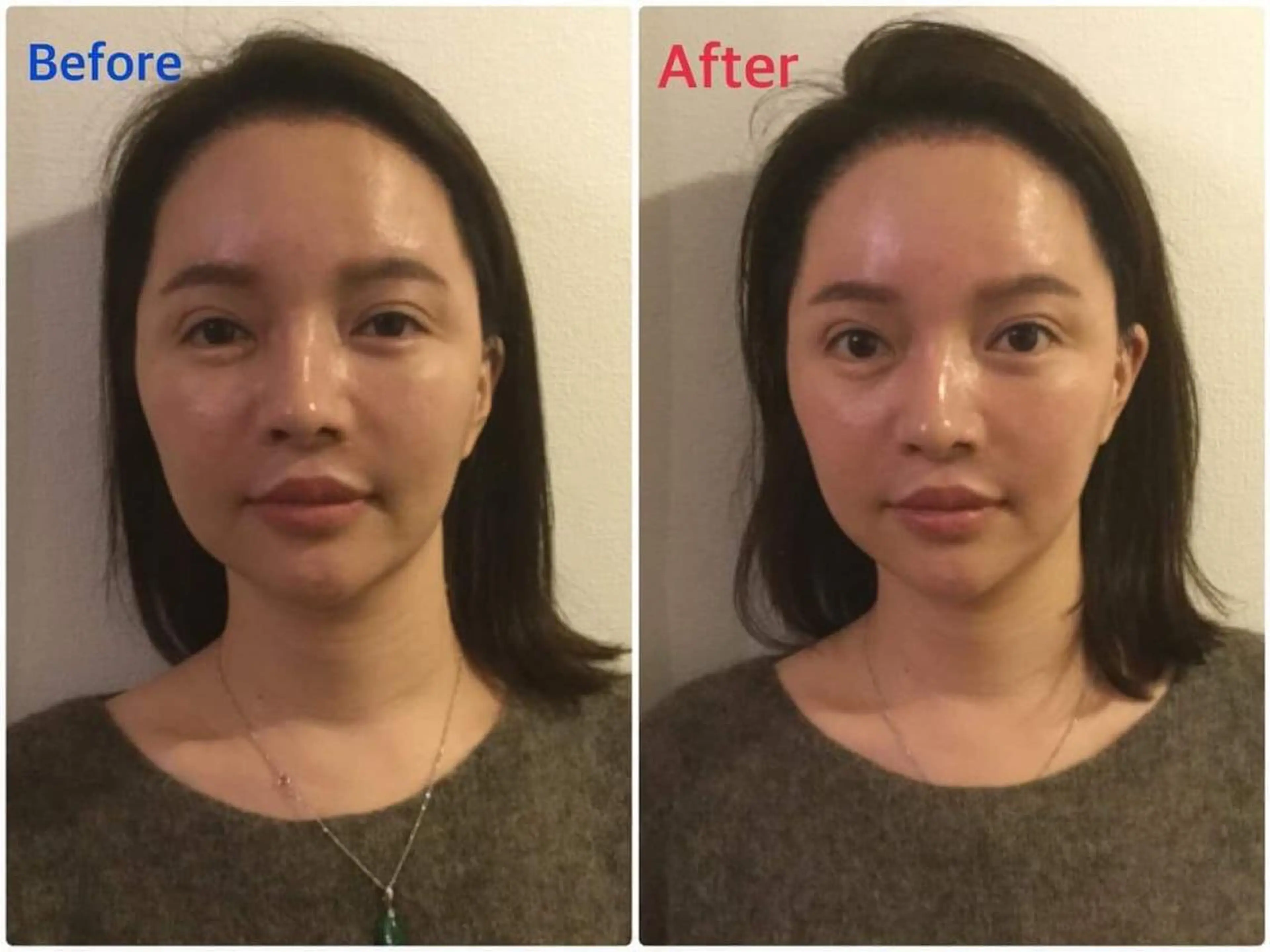 【年末キャンペーン11/15-12/30】小顔矯正ショート　2980円の写真