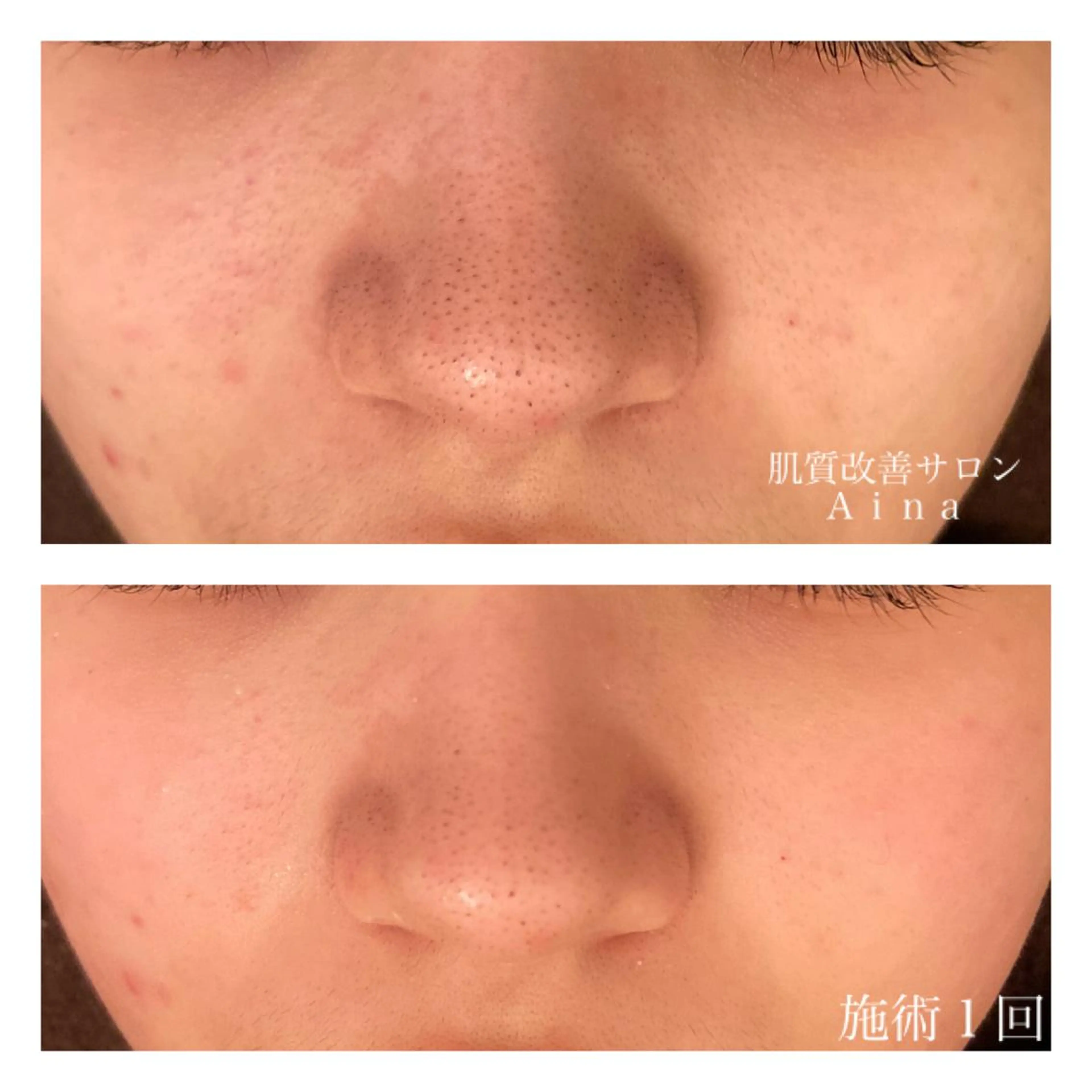 ミディアム カラー パーマ ヘアアレンジ メンズ キッズ ネイル マツエク・マツパ ニキビ跡専門サロン Ａｉｎａのエステ・リラクイメージ