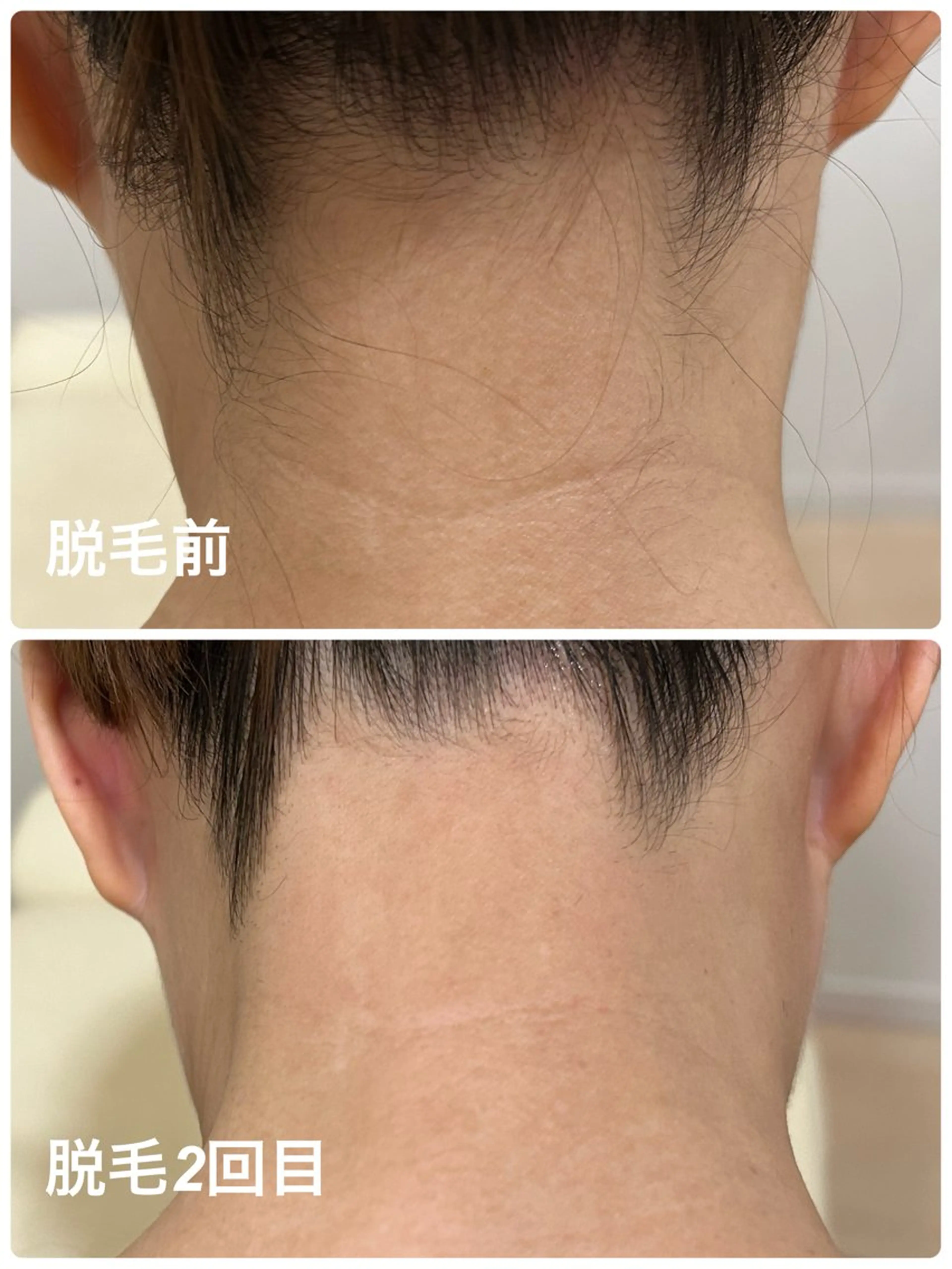 【横顔＆後ろ姿レベルUP】つるすべうなじ脱毛　4,500円→3,000円の写真