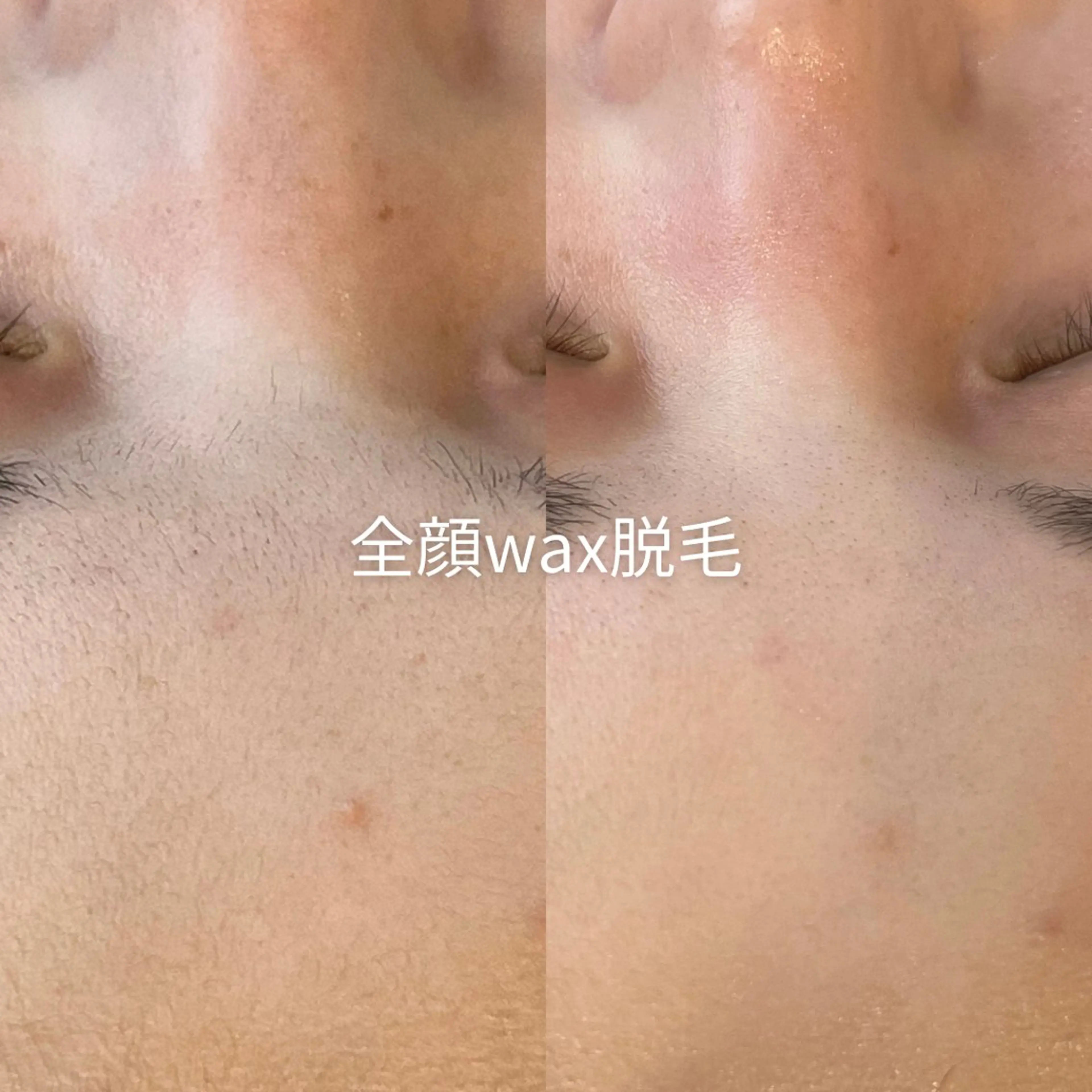 脱毛 EST BEAUTY所属・顔ワックス脱毛/ ハーブピーリングのエステ・リラクイメージ