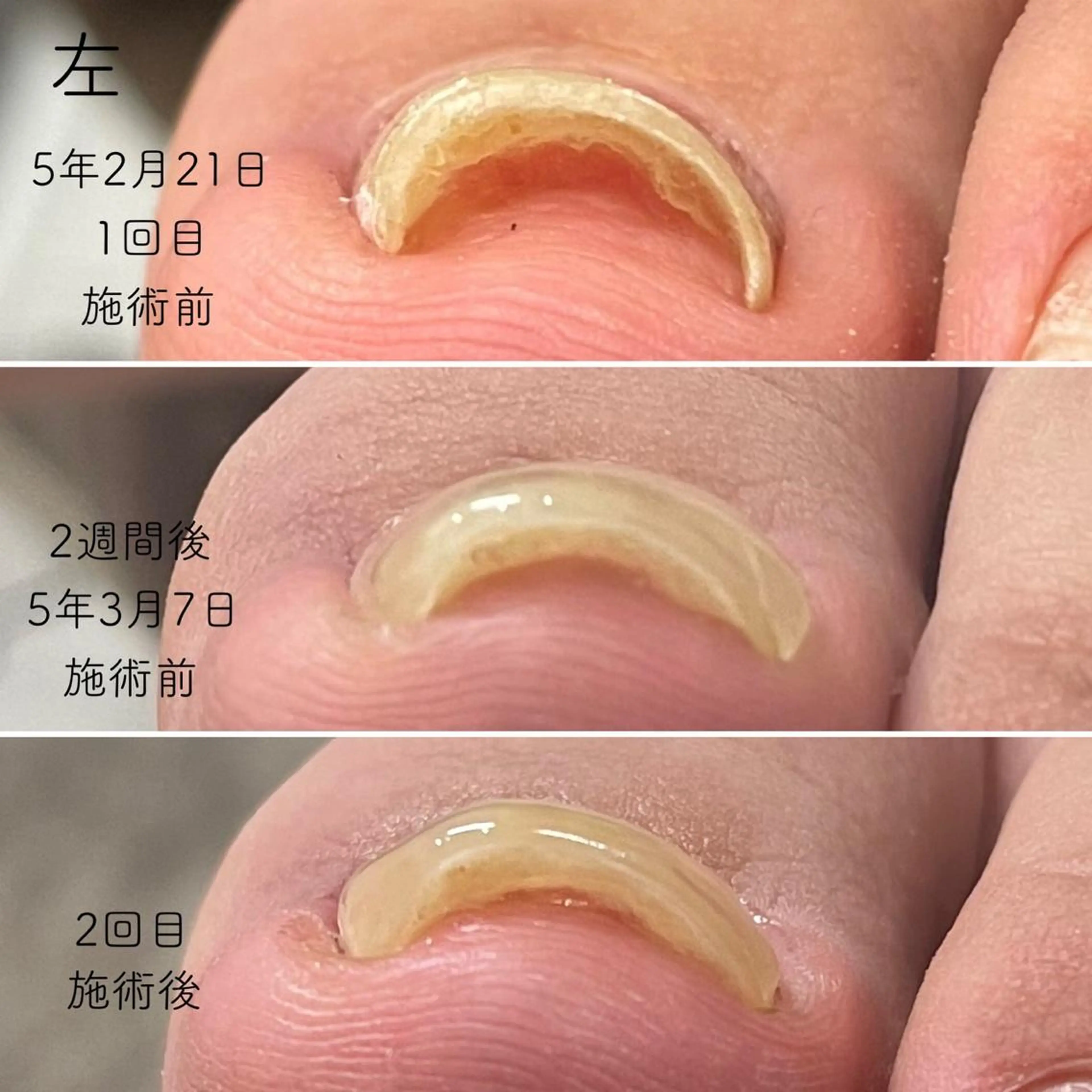 【巻き込んだ爪でお悩みの方へ】ジェルで巻き込んだ爪の緩和(2本分)男性もOKの写真