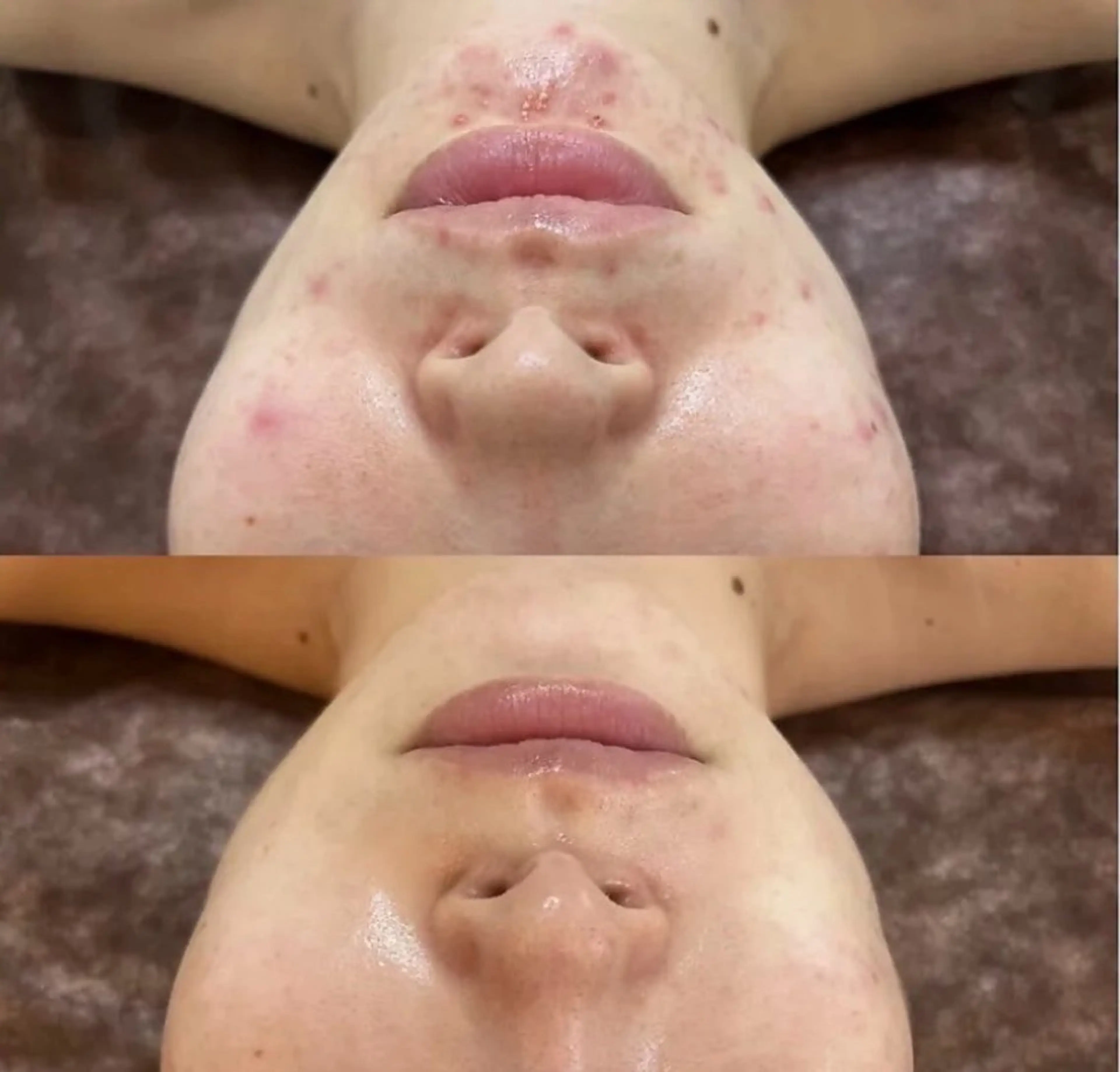 【しつこいニキビケア】REVIハーブピーリングの写真