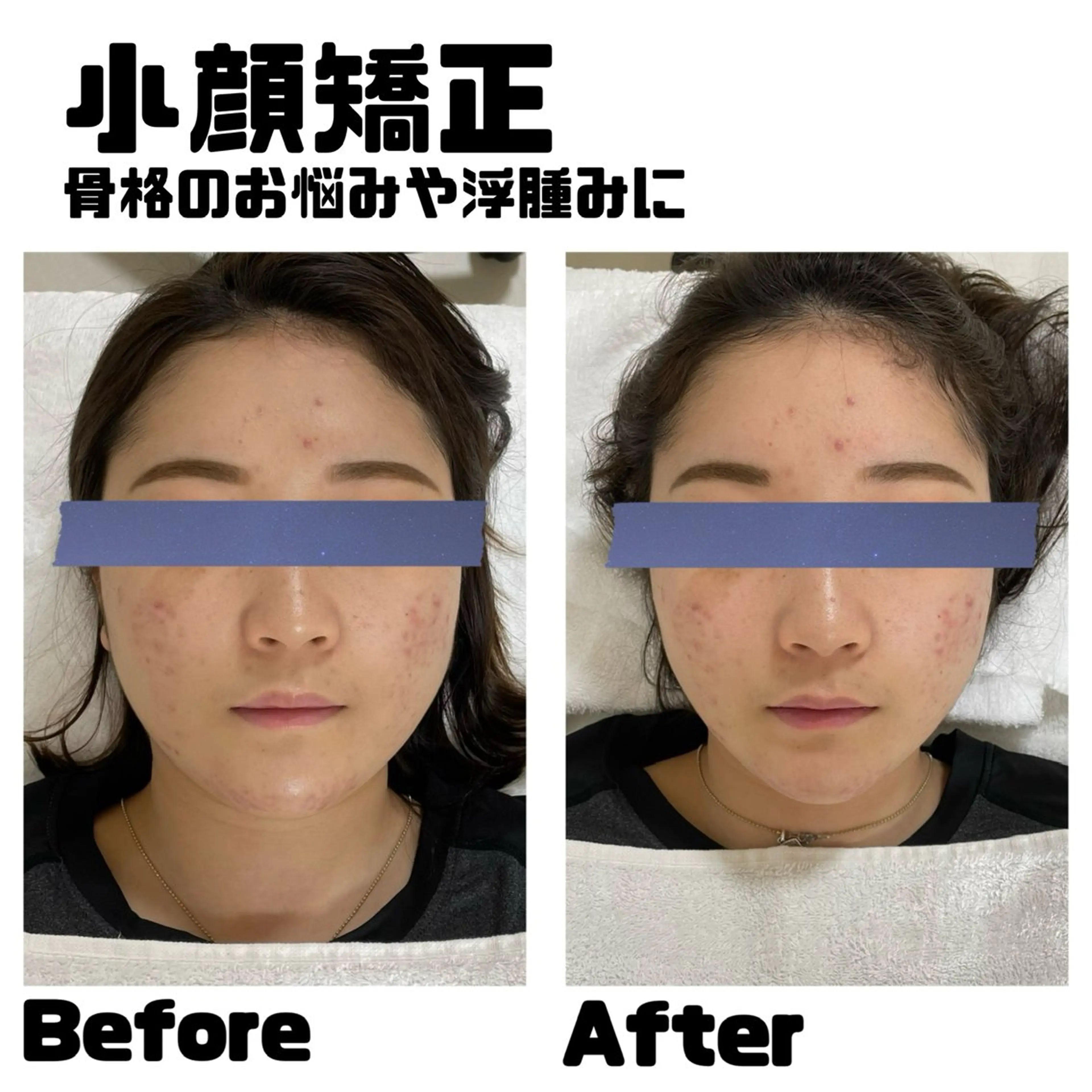 フェイシャルNo.1🌟小顔矯正🌟30分でさくっと小顔❣️メイクしたままOK🙆‍♀️ 骨格のお悩み・むくみに✨の写真