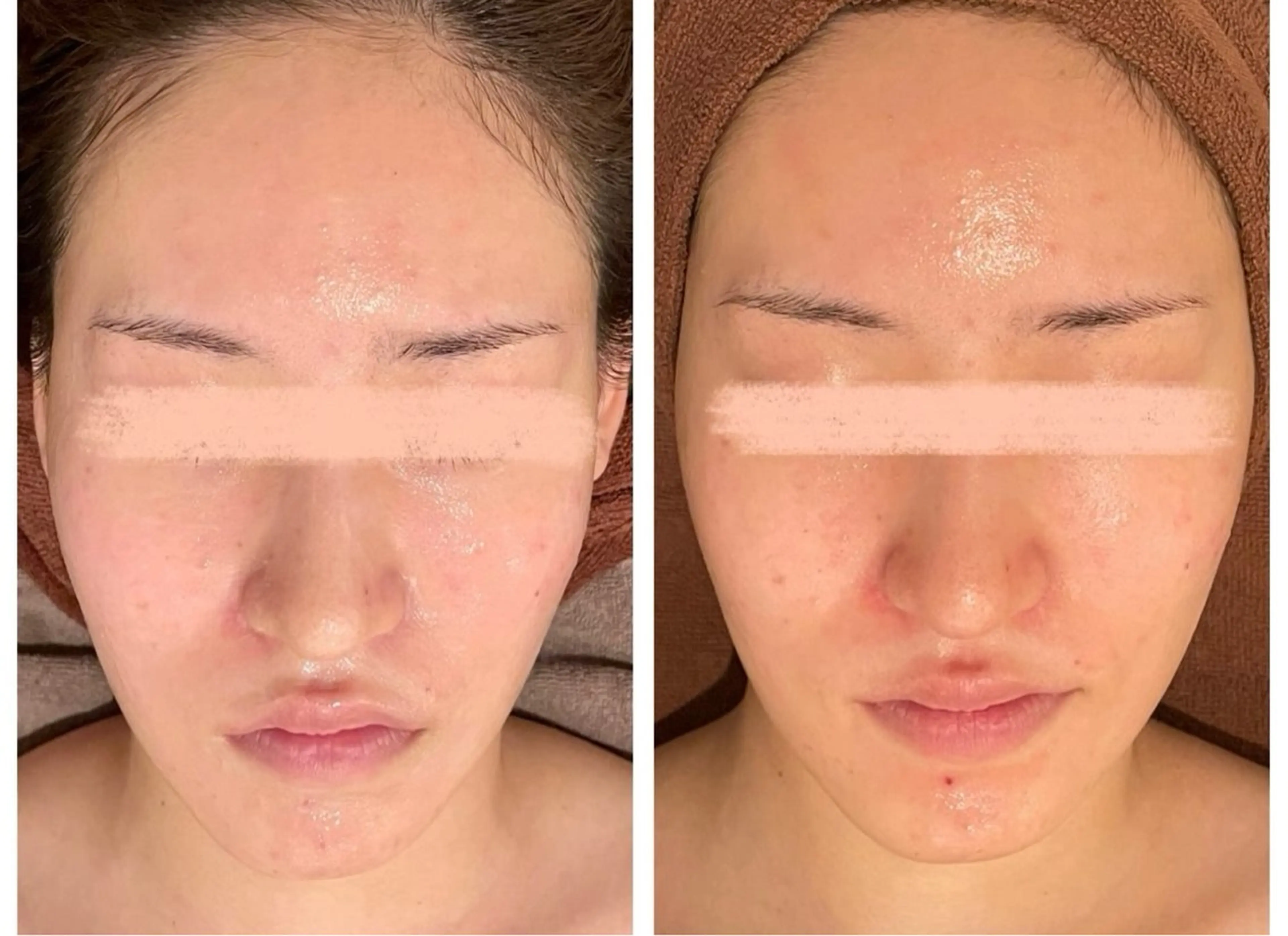 エステ Meow！～トラブル肌専門ピーリング＆脱毛サロン～所属・トラブル肌改善🏥 Meow！🫧🫧のその他イメージ