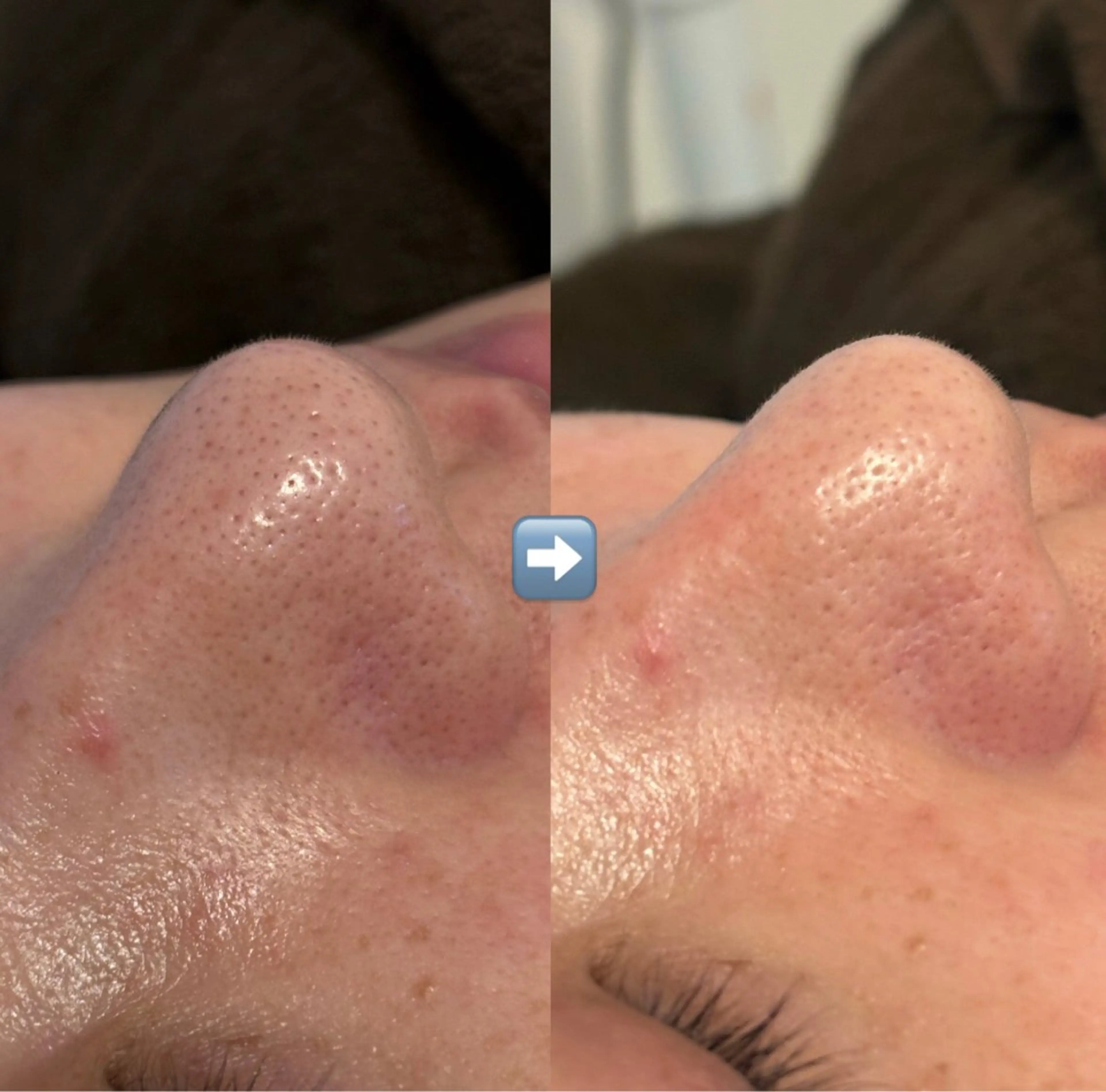 ハイドラフェイシャル(毛穴洗浄)の写真