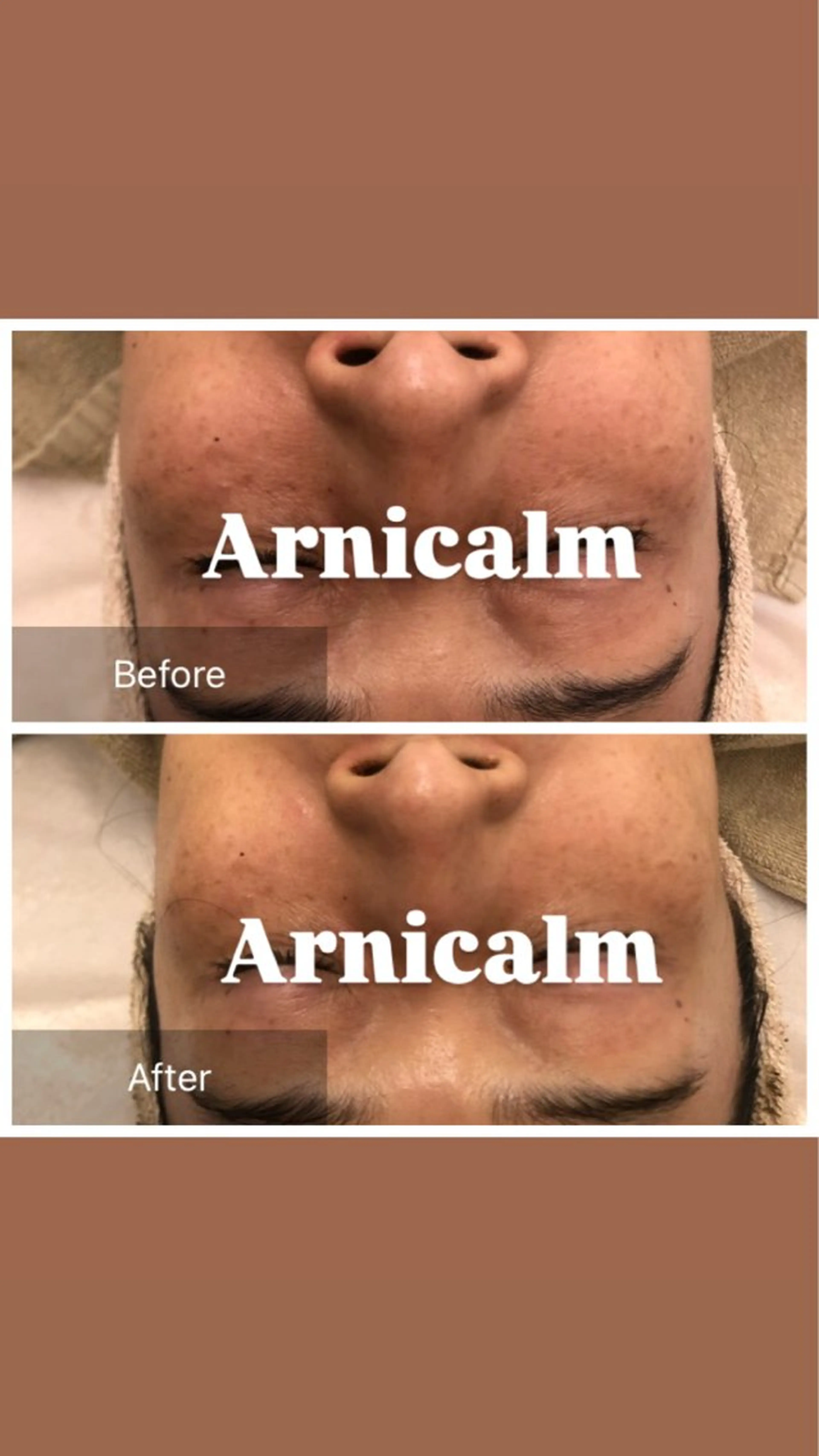 エステ ハーブピーリング 肌再生ピーリング/のエステ・リラクイメージ