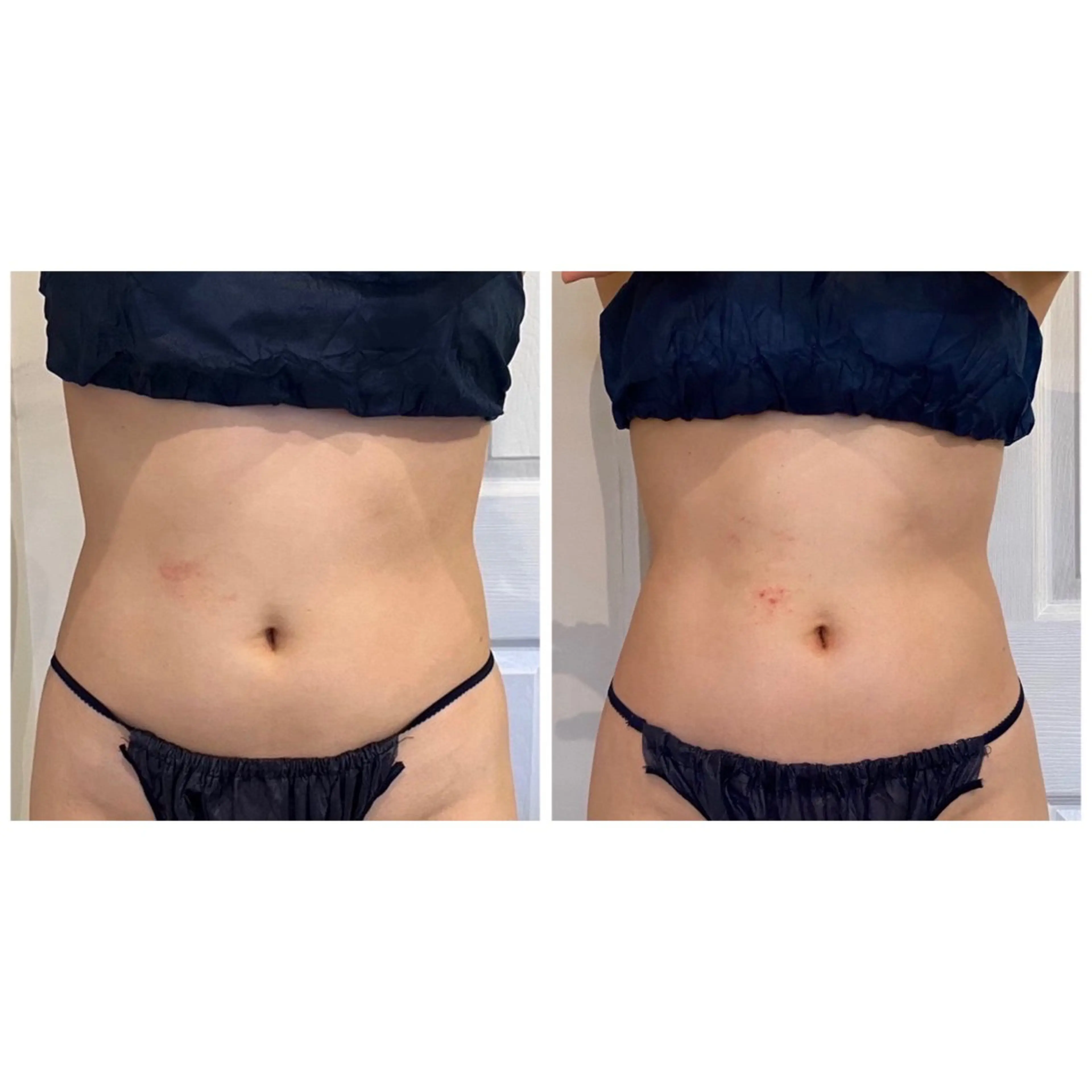 【男女】脂肪除去　身体1部位（10ml）の写真