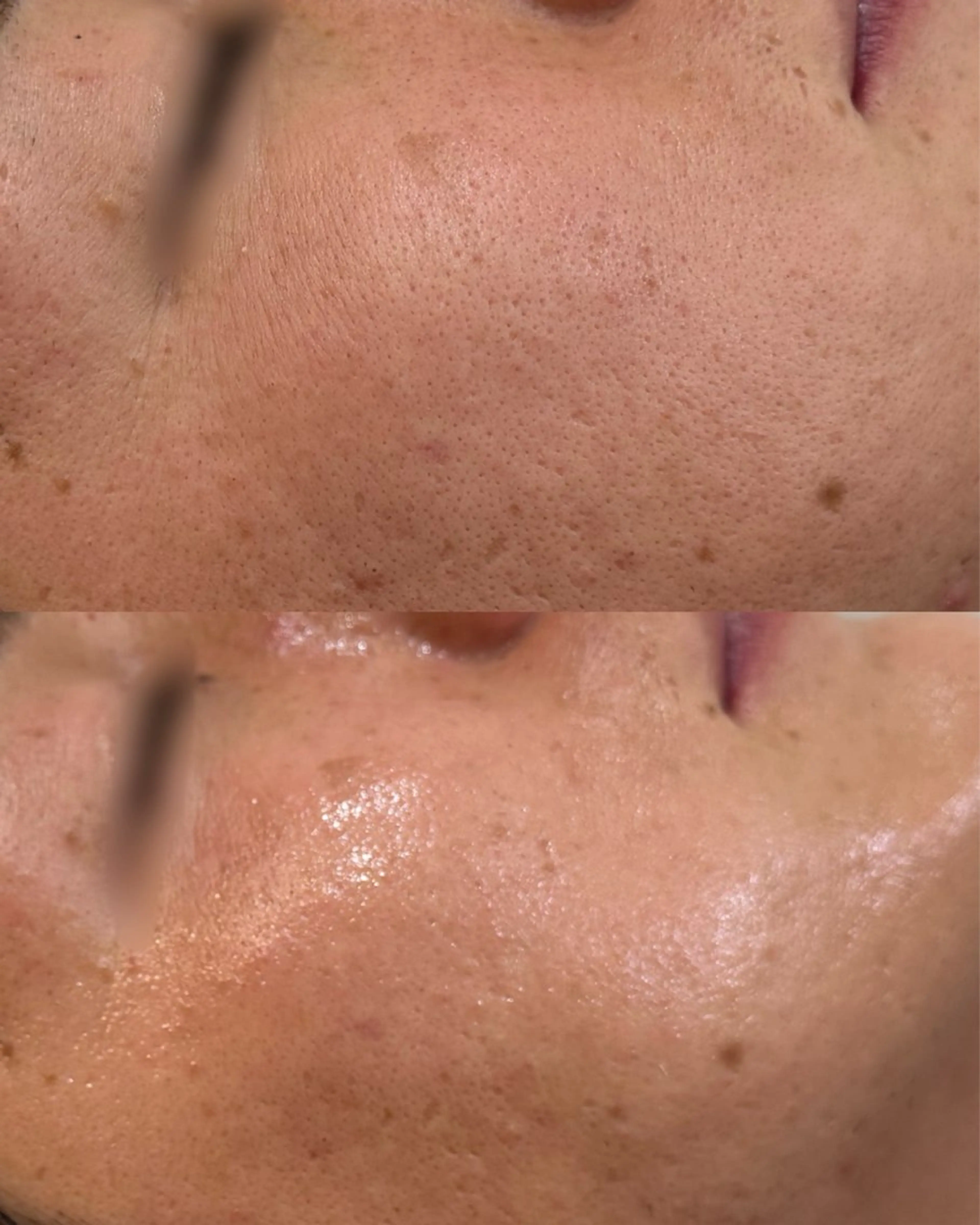 【黒ずみ角栓ごっそり】の写真