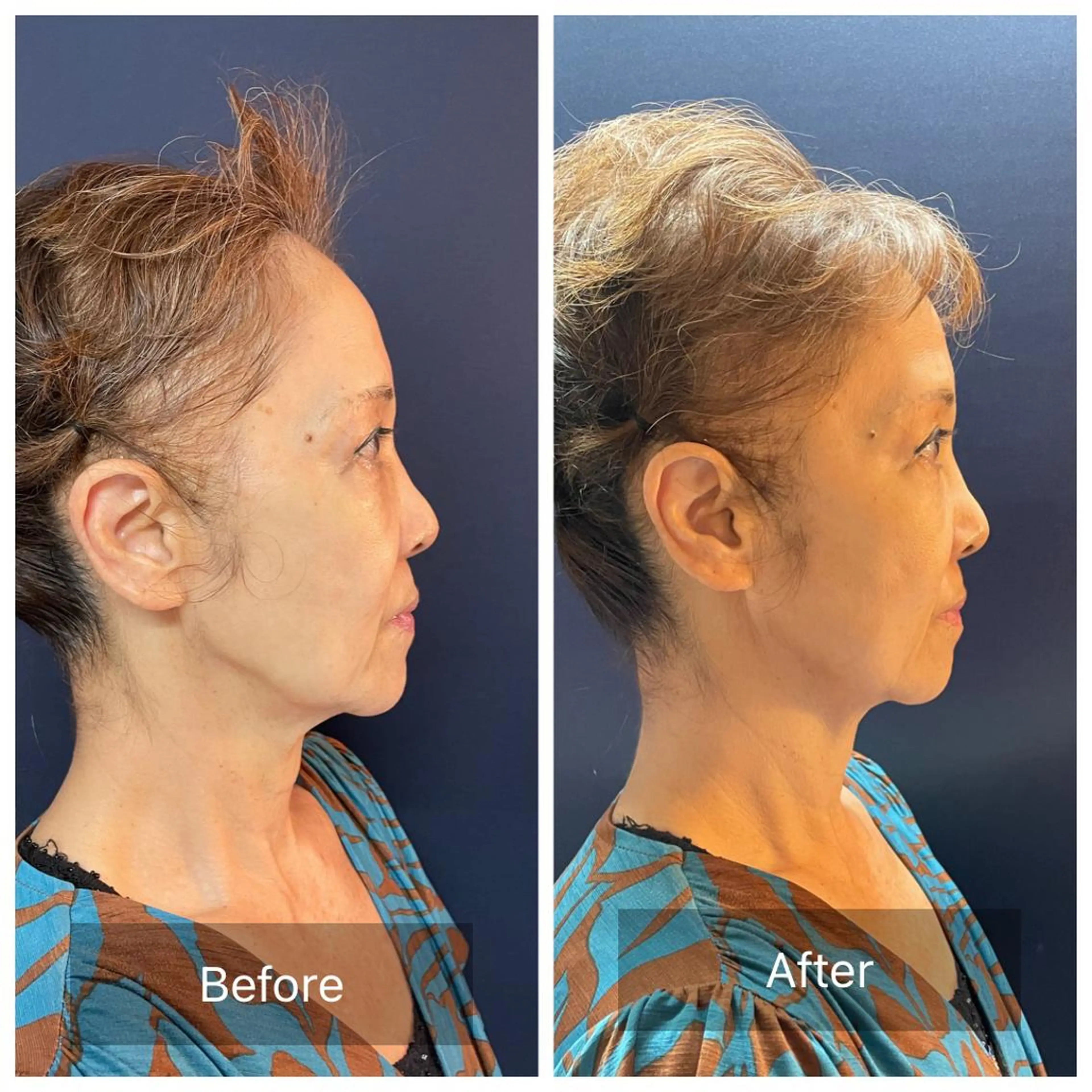 美楽鍼 びらくしんのその他イメージ