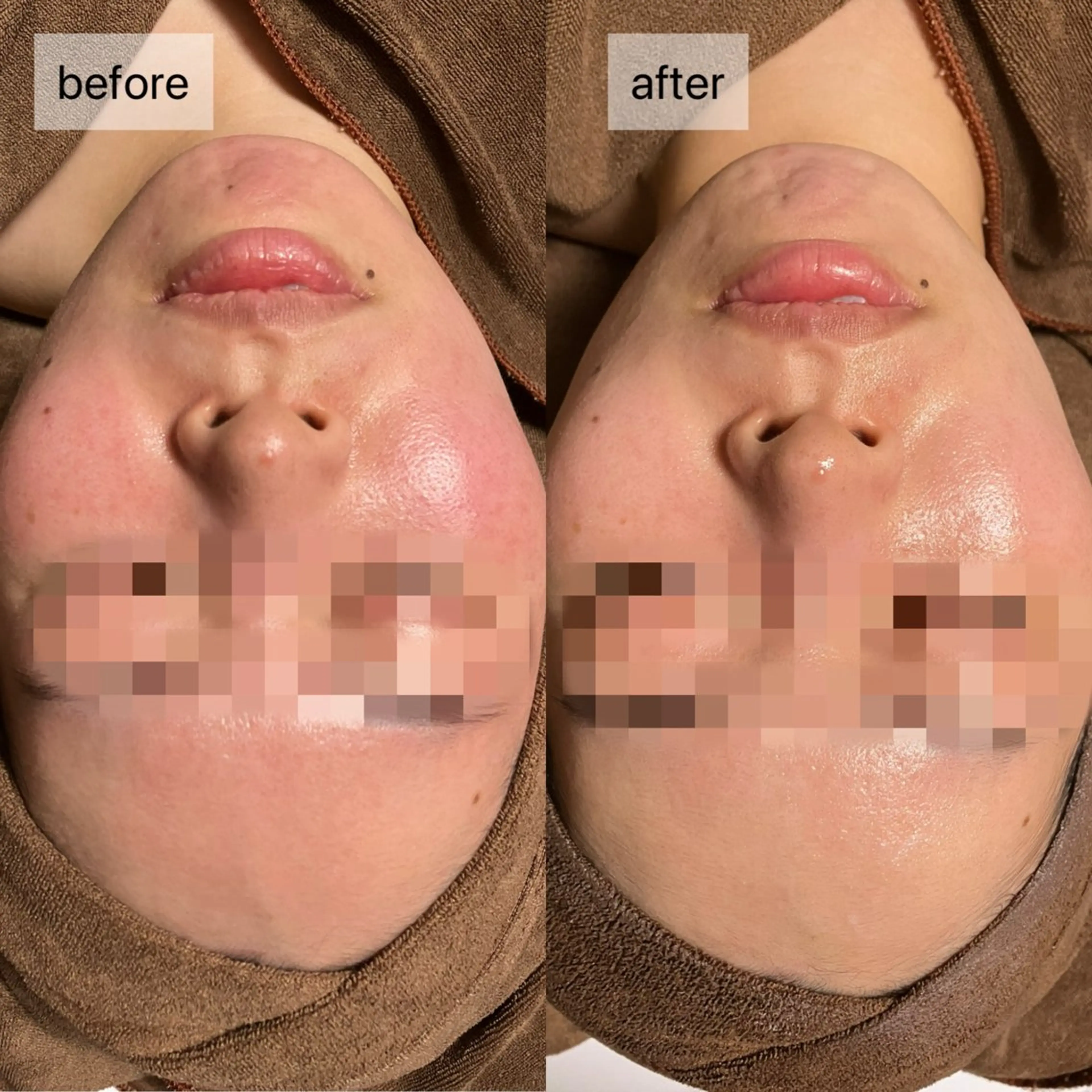 エステ HINANO矢場町店【ヒナノ】所属・脱毛/肌改善🌿 HINANO 村田のエステ・リラクイメージ