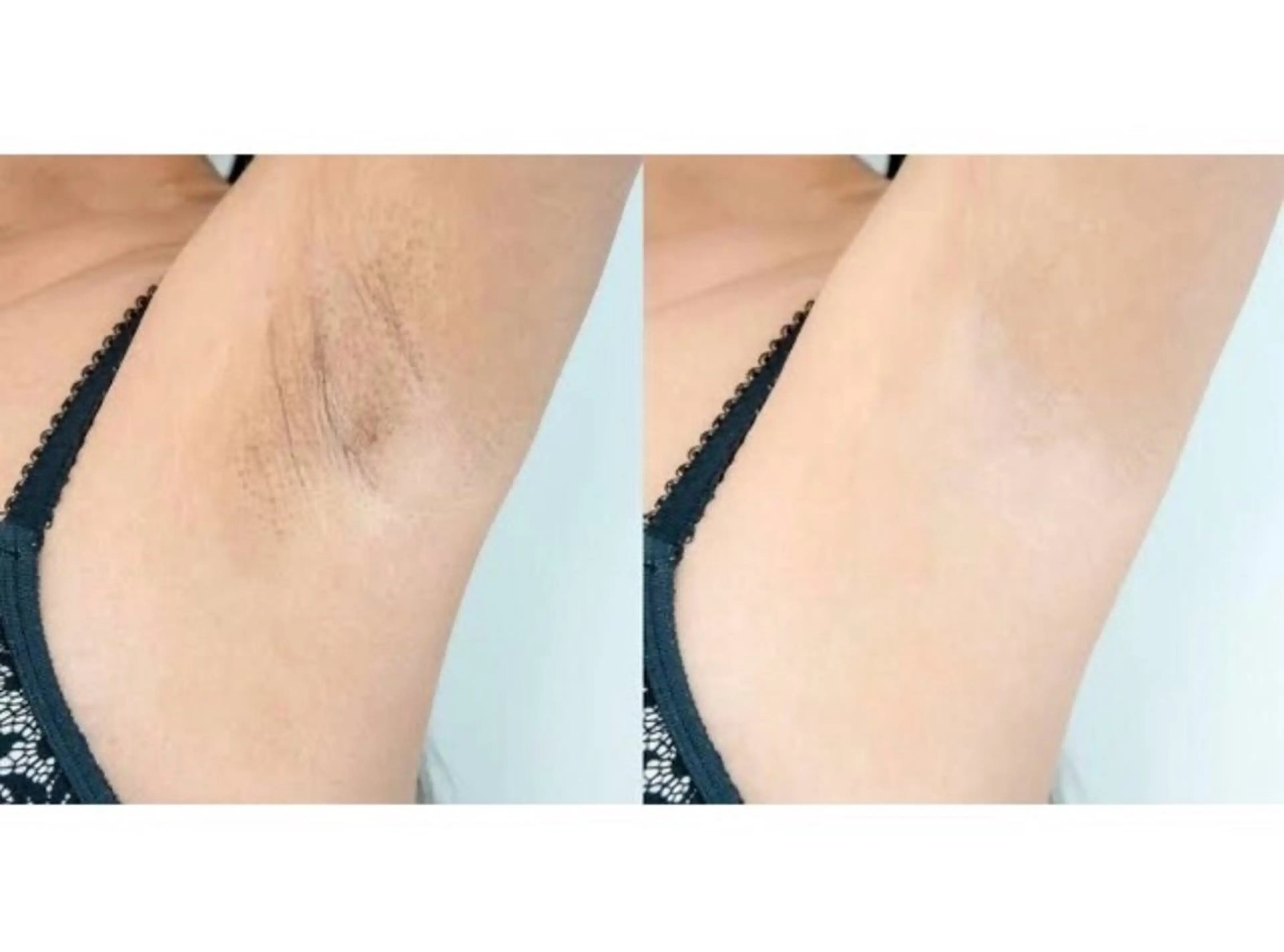 薄着になる季節におすすめ✨【脇の黒ずみ悩みの方へ】両脇ハーブピーリングの写真