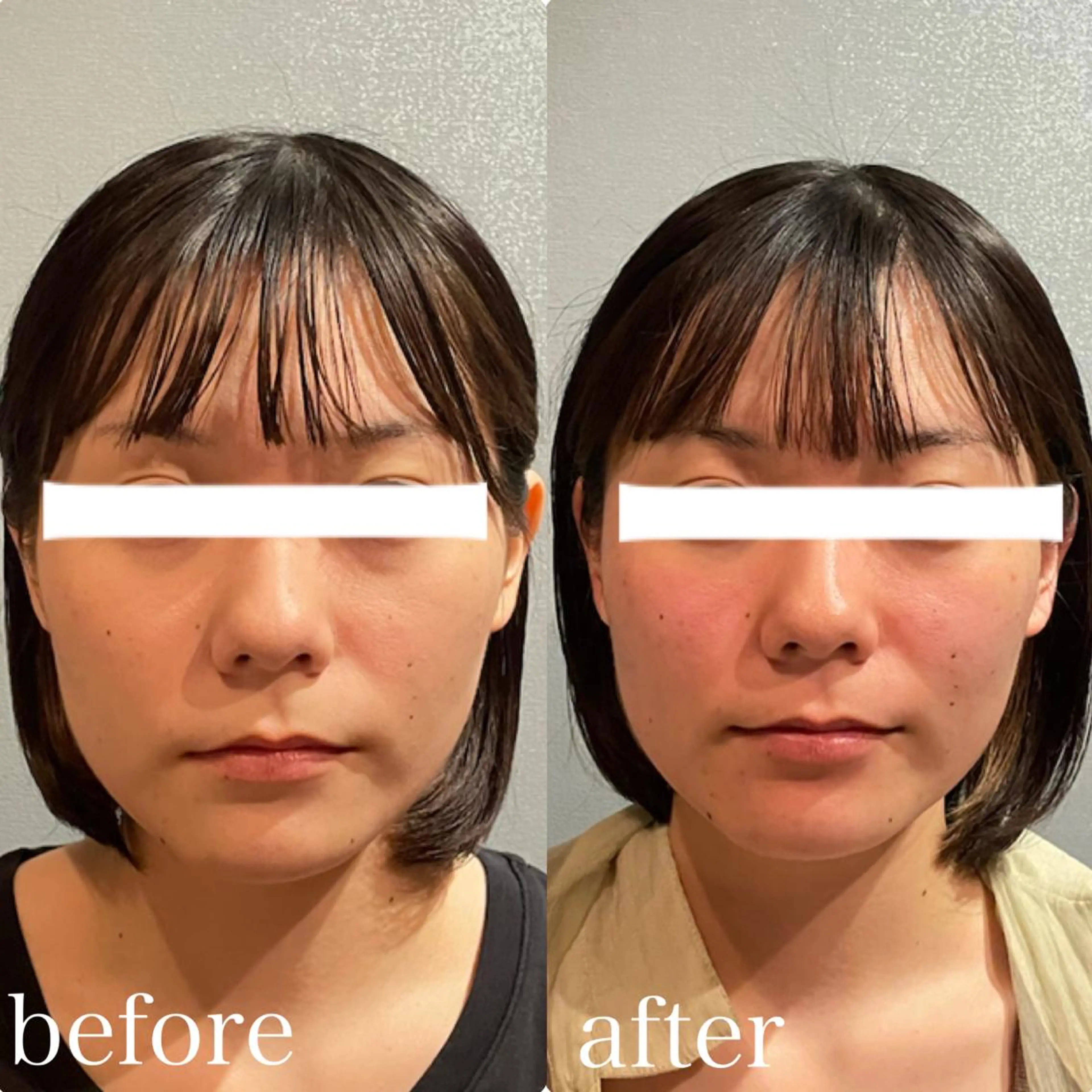 当店人気No.2☆小顔コルギ+頭蓋骨調整+デコルテ★の写真