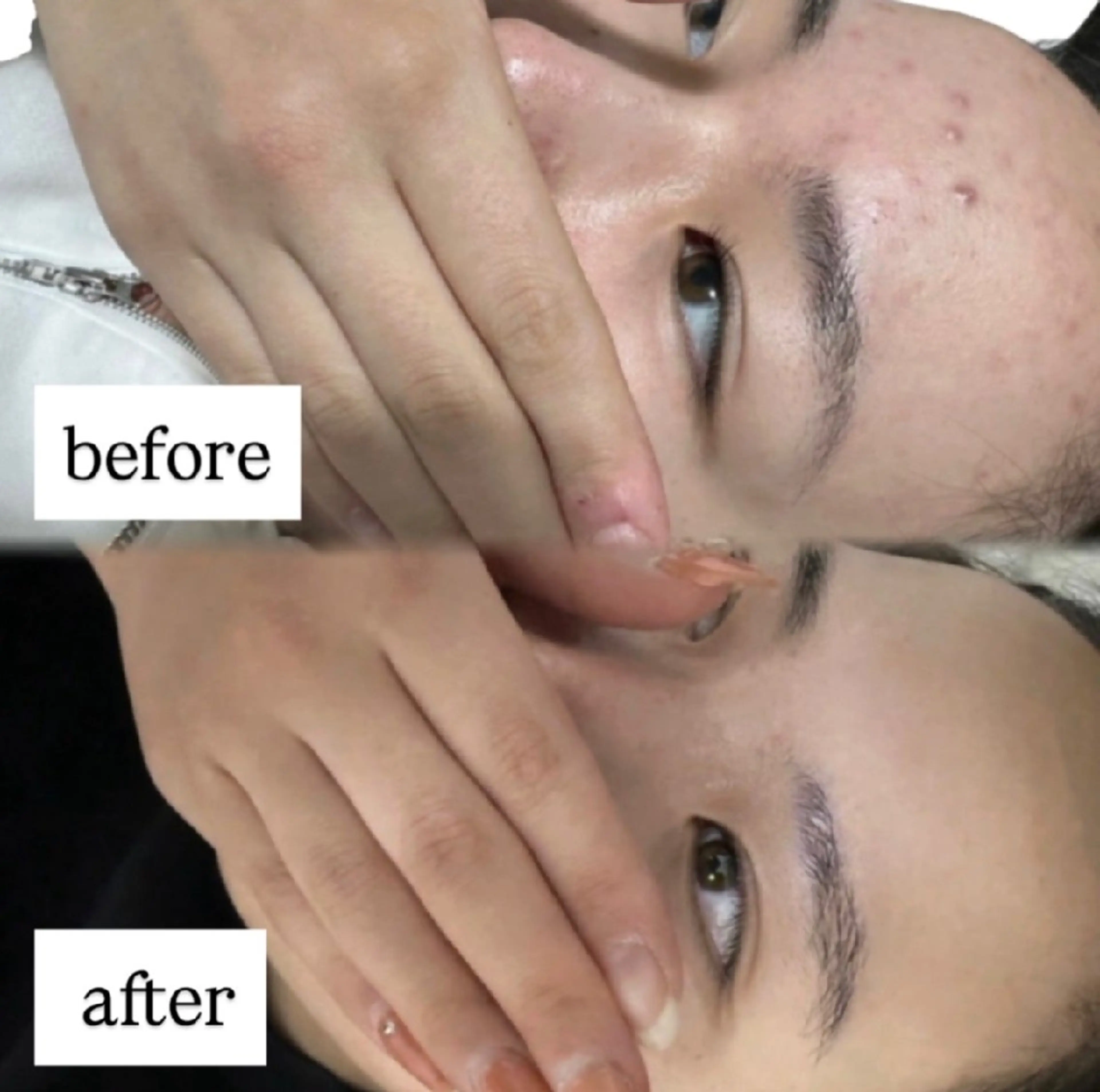 [口コミ必須🙏]4月限定クーポン一番人気！🌿毛穴洗浄×ハーブピーリング🌿の写真