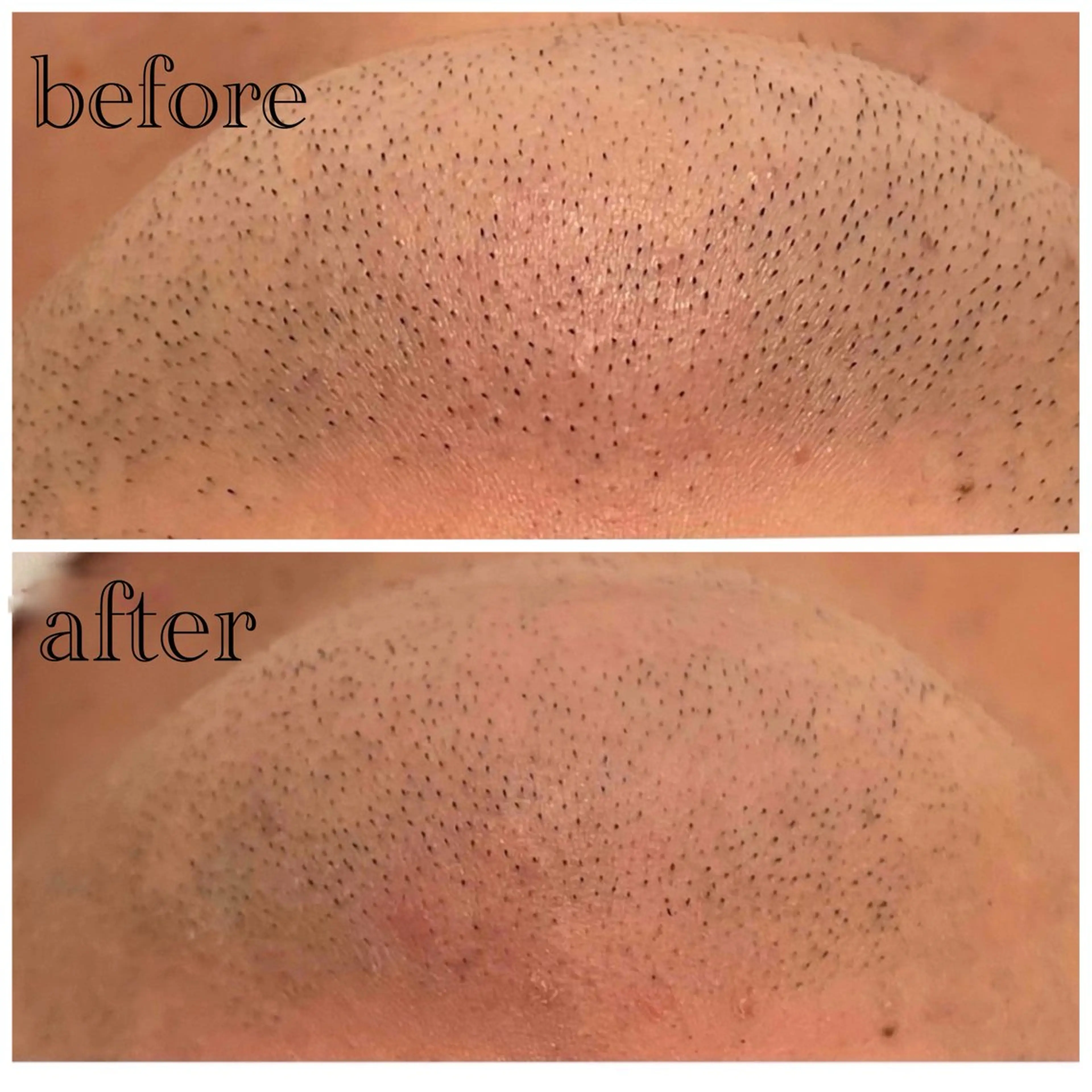 メンズ限定！ご新規様【ミニモ限定】自分で選べる部分脱毛✨✨の写真