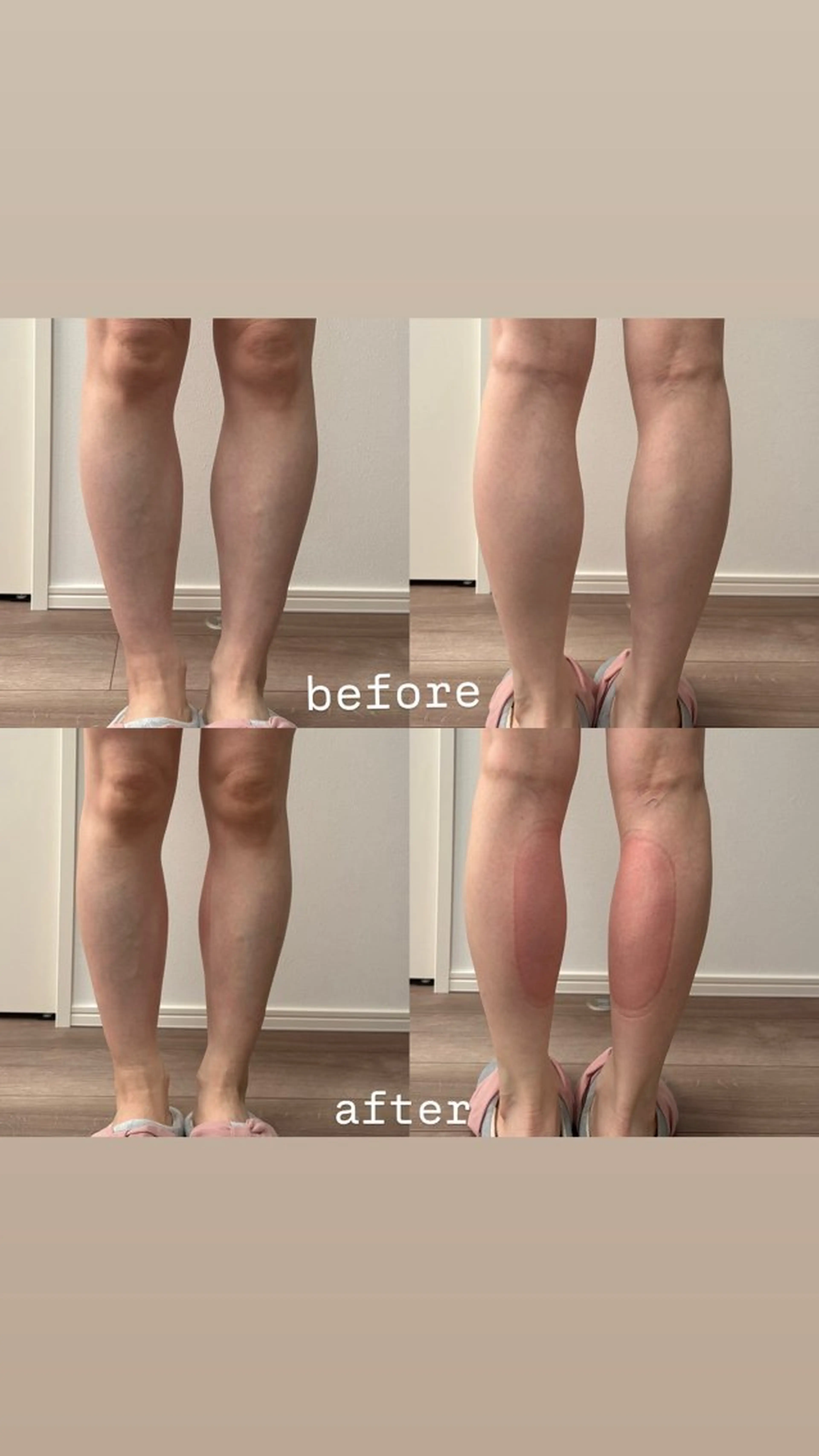 エステ Miiju.所属・Miiju. 石巻市 脂肪冷却  鈴木のエステ・リラクイメージ