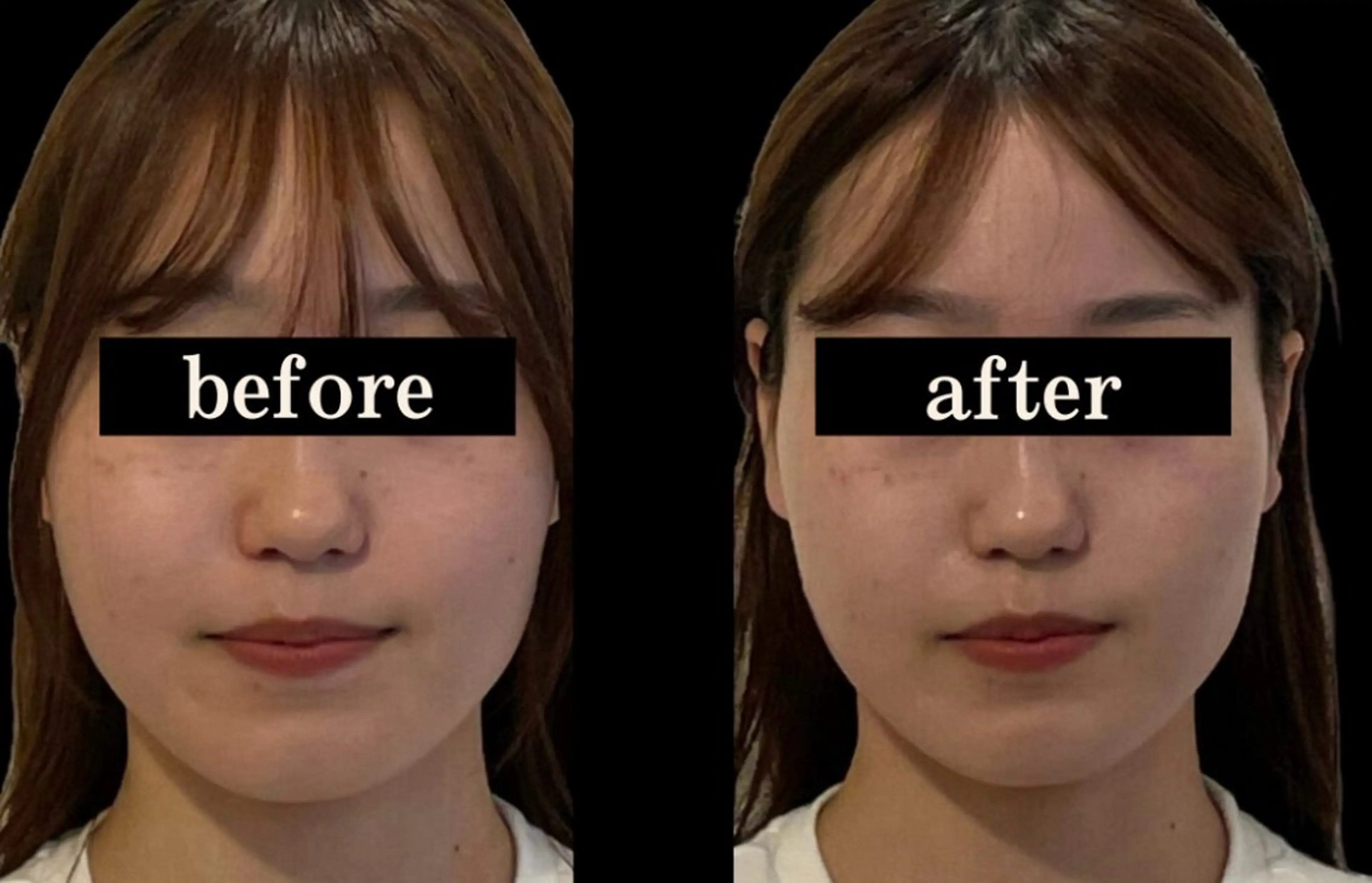 エステ 小顔/たるみ/黒ずみ除去専門サロン/SONA 大和西大寺店所属・【小顔専門看護師 サロンSONA】のエステ・リラクイメージ