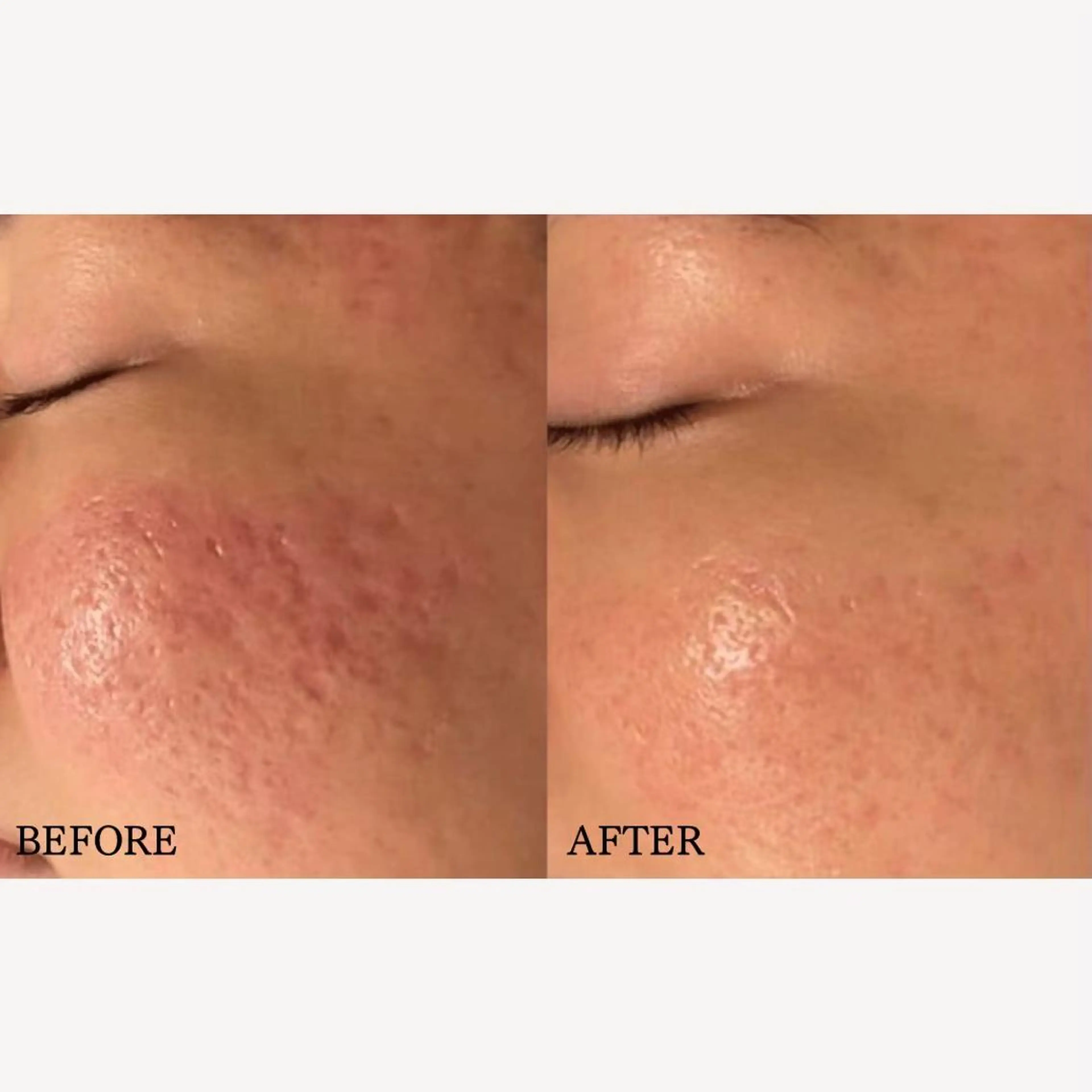 モニター価格[肌質凹凸ケア]サーマトリックス使用！幹細胞導入/90分の写真