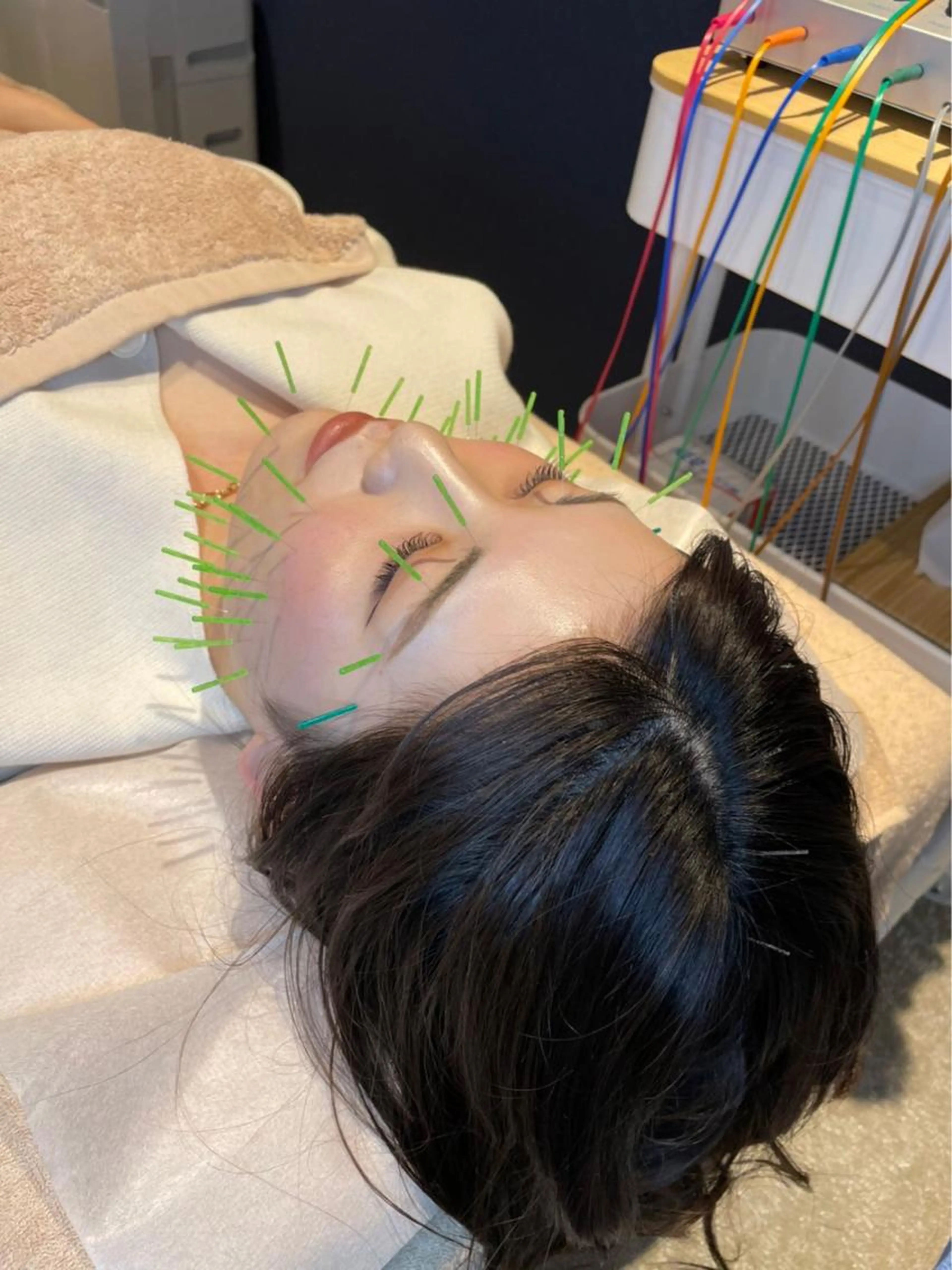 初回限定❗️肌再生美容鍼50本＋首、お顔、頭皮マッサージ付き【ニキビ、肌荒れ、乾燥肌、化粧水の浸透を高めたい方向け✨】の写真