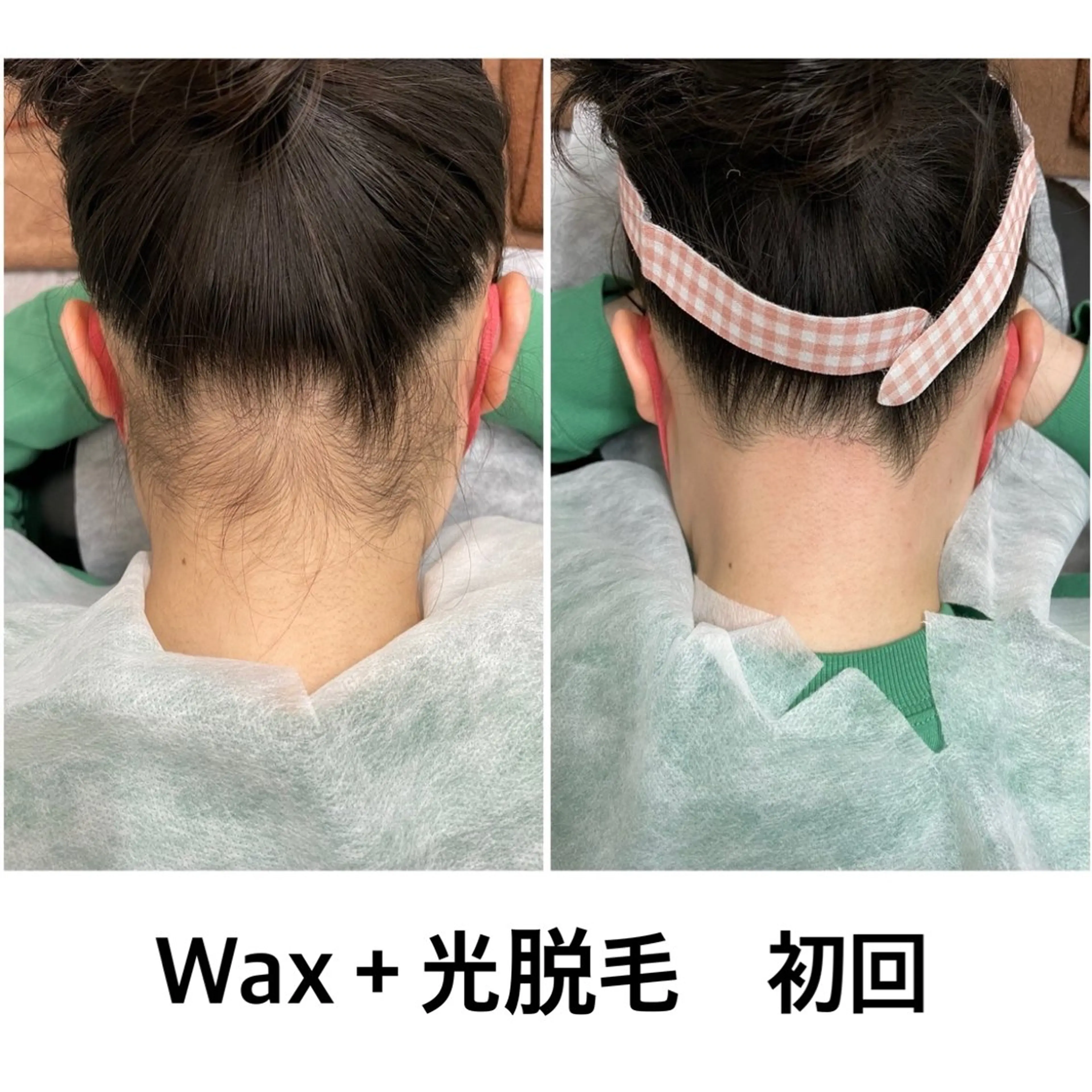 【学割U24/24歳以下以下なら社会人もOK！】うなじワックス脱毛¥2800の写真