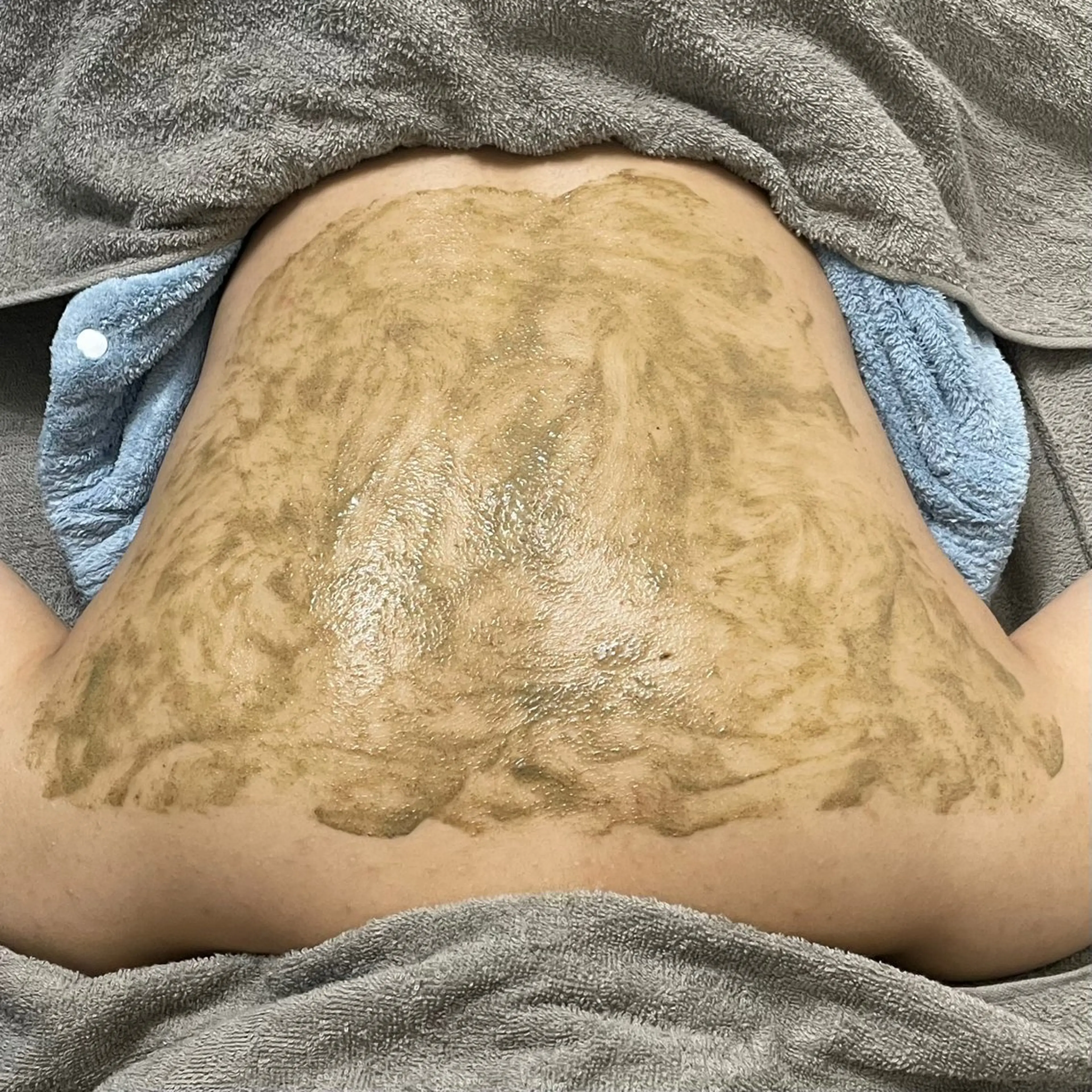 ハーブピーリング【背中】の写真