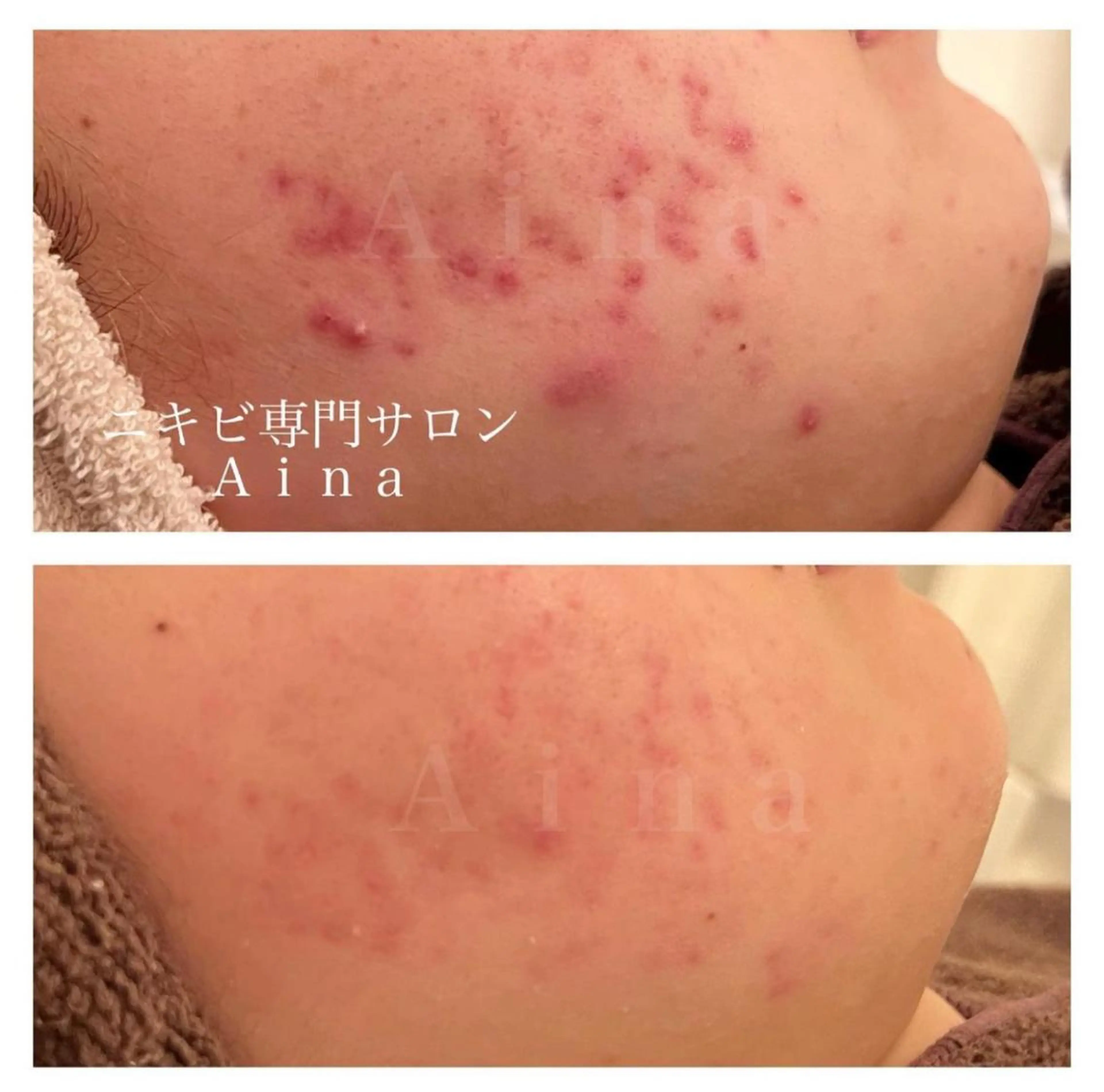 ショート カラー パーマ ヘアアレンジ メンズ キッズ ネイル マツエク・マツパ アイブロウ 赤色 ニキビ跡専門サロン Ａｉｎａのエステ・リラクイメージ