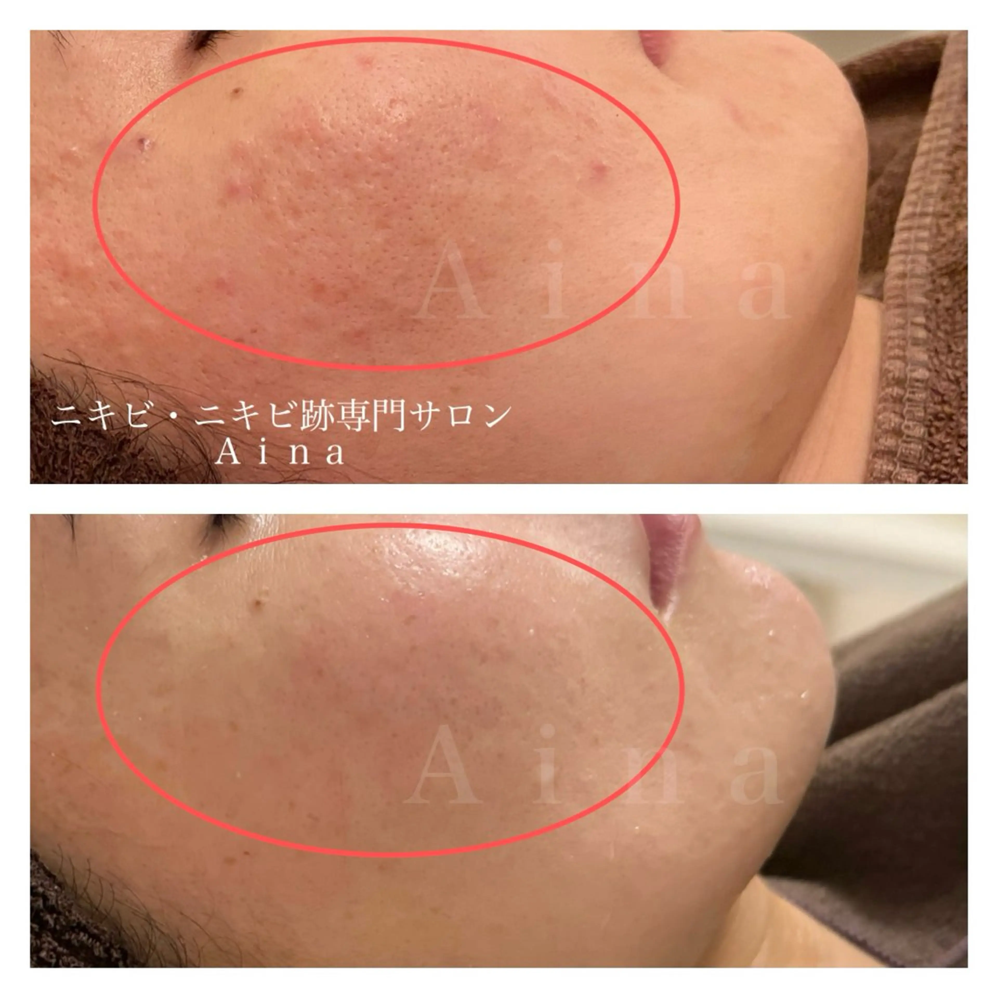 エステ リラク ニキビ跡専門サロン Ainaのエステ・リラクイメージ