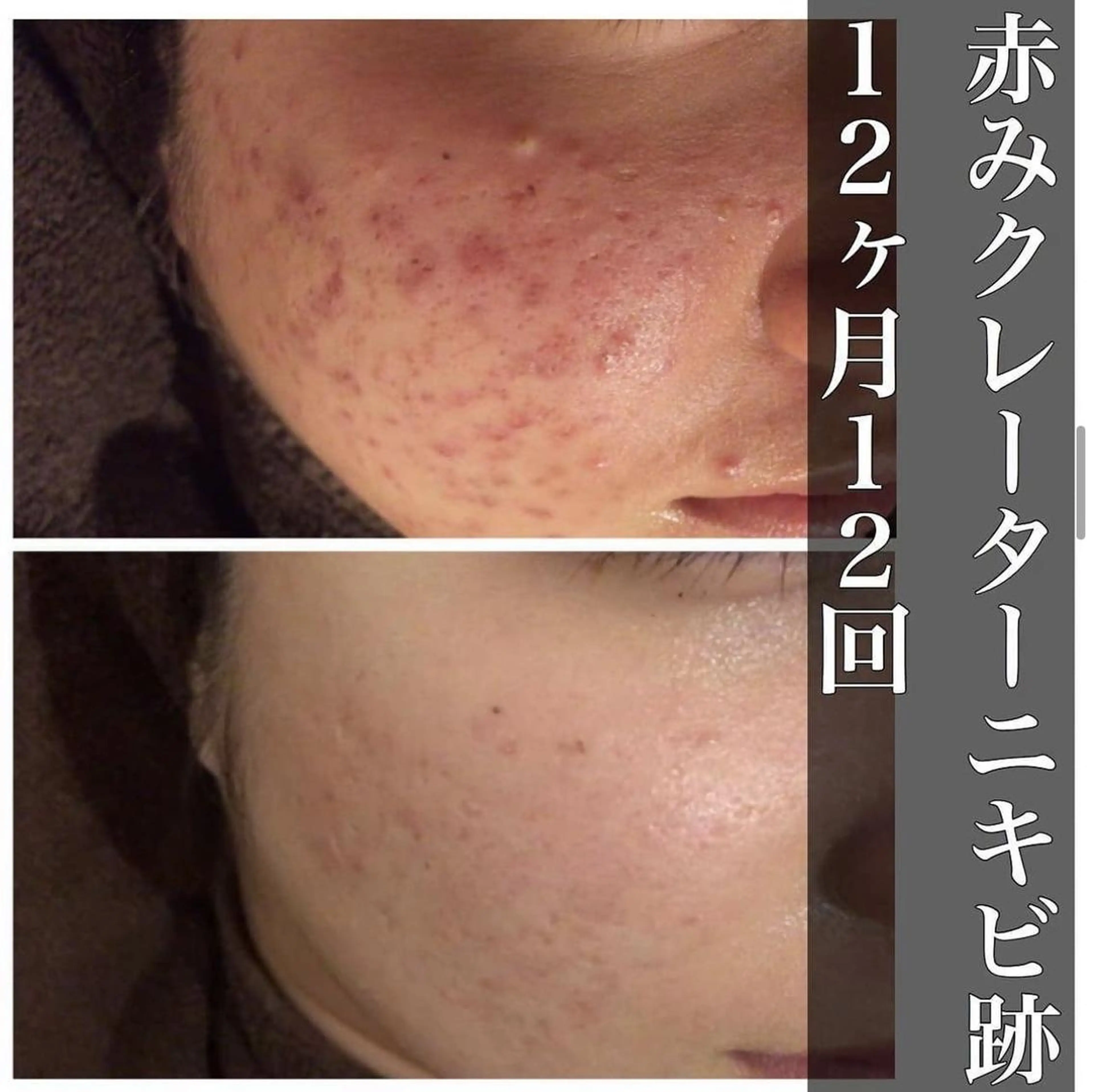 ショート メンズ キッズ マツエク・マツパ ネイル アイブロウ カラー パーマ ヘアアレンジ ニキビ跡改善専門🔥 医療にはできない改善のエステ・リラクイメージ