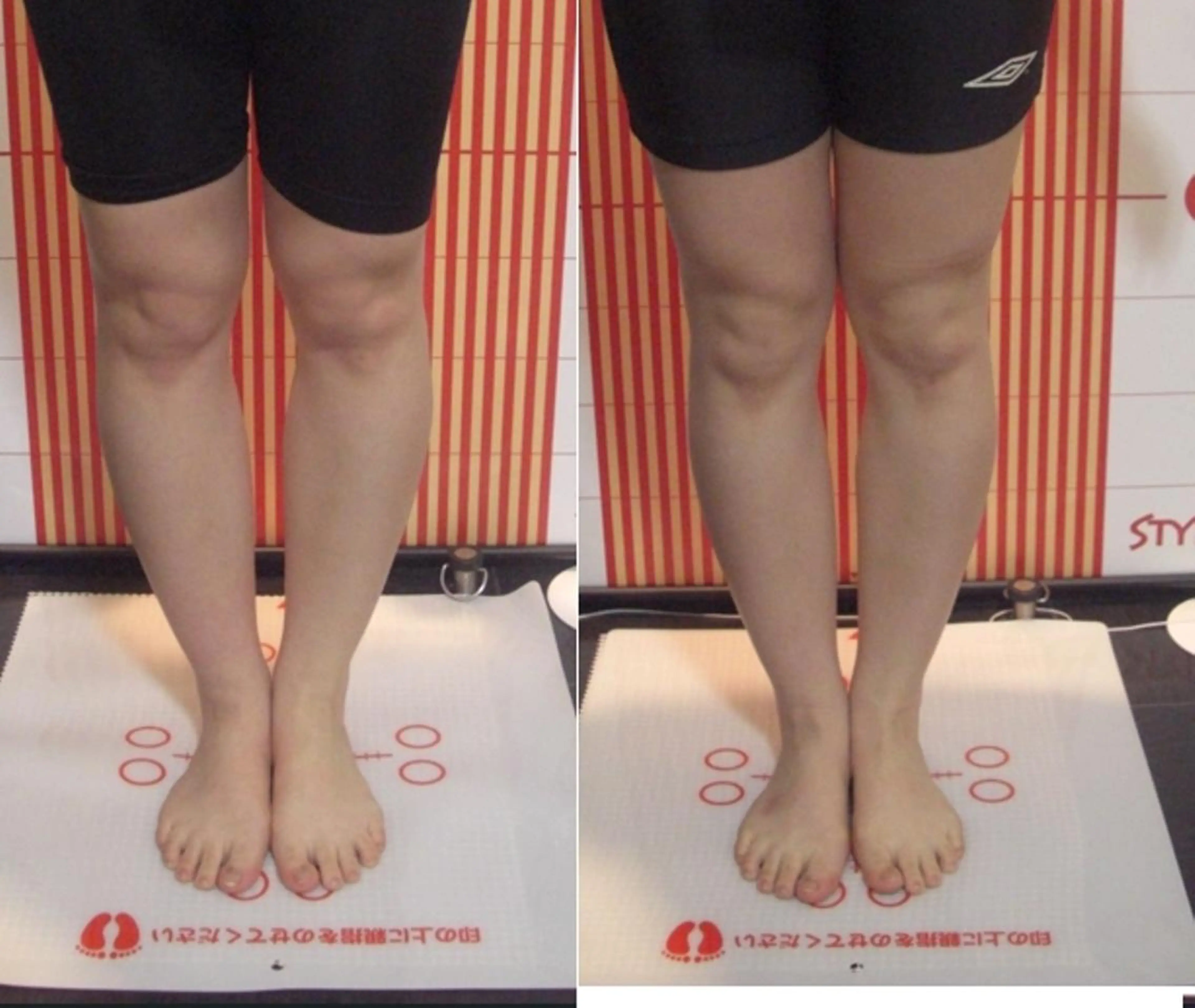 美脚、O脚、X脚、姿勢改善、骨盤矯正コース　50分　￥9900の写真